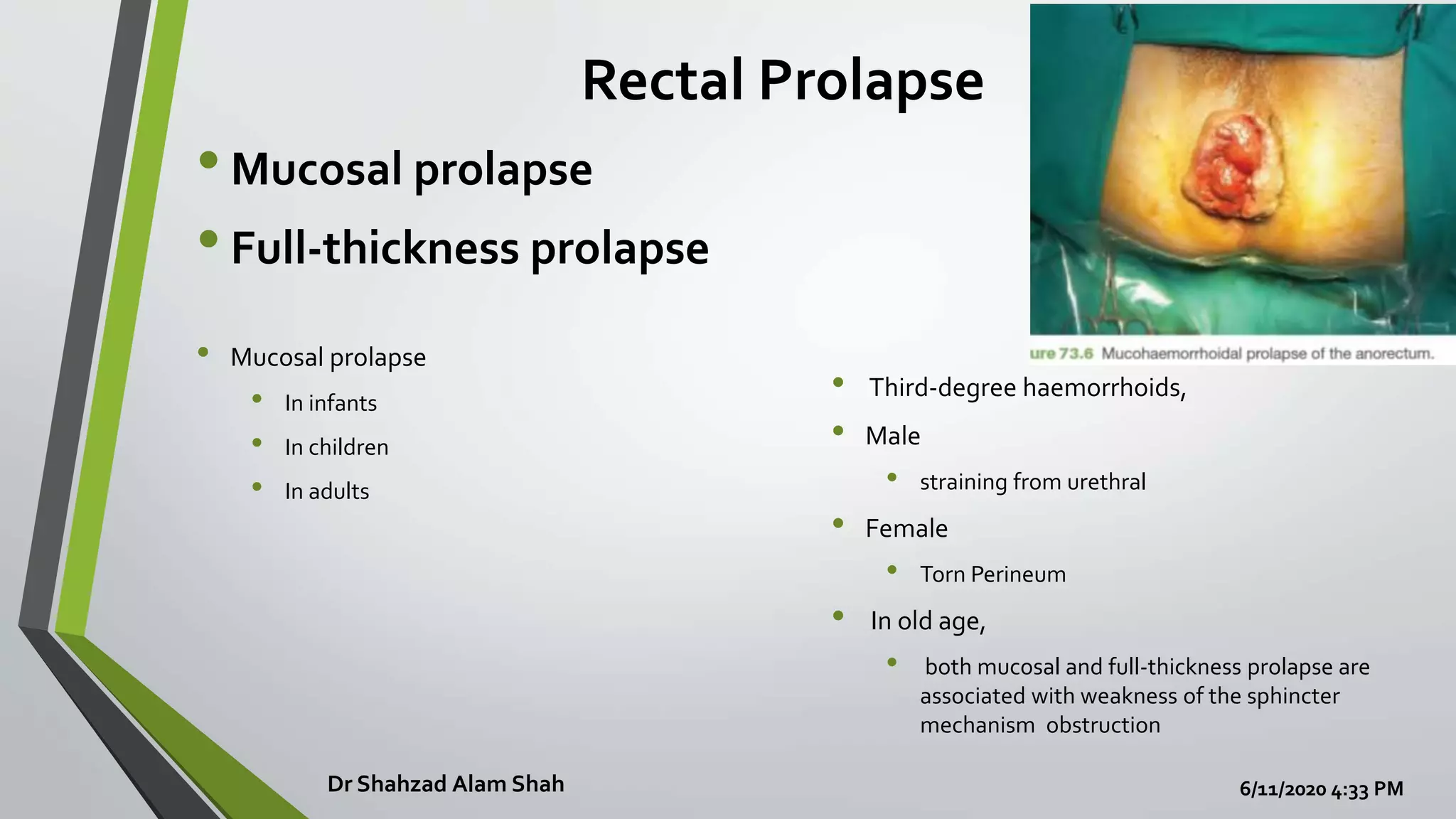 Prolapsed Bowel Pictures