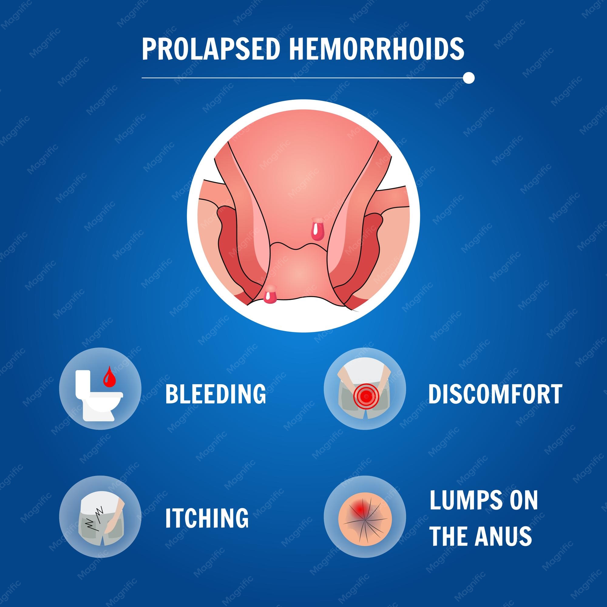 Prolapsed Internal Hemorrhoids