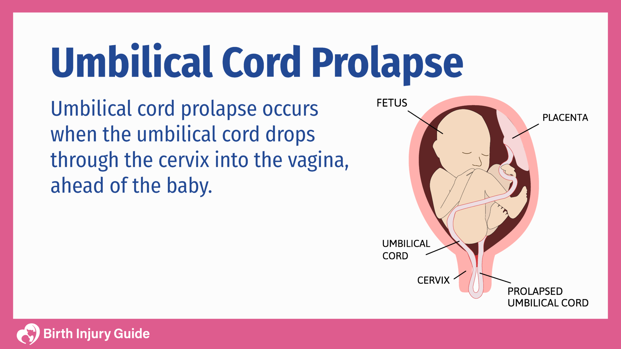 Prolapsed Umbilical Cord