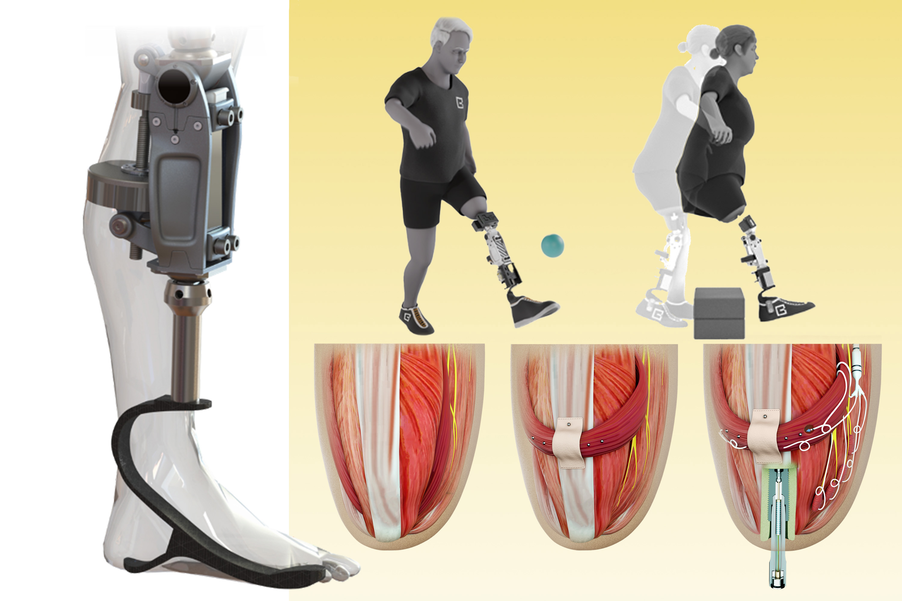 Prosthetic Leg Back To Normal