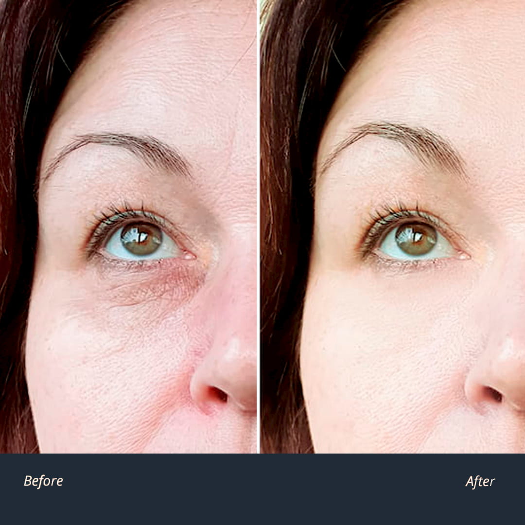 Puffy Eyes Treatment