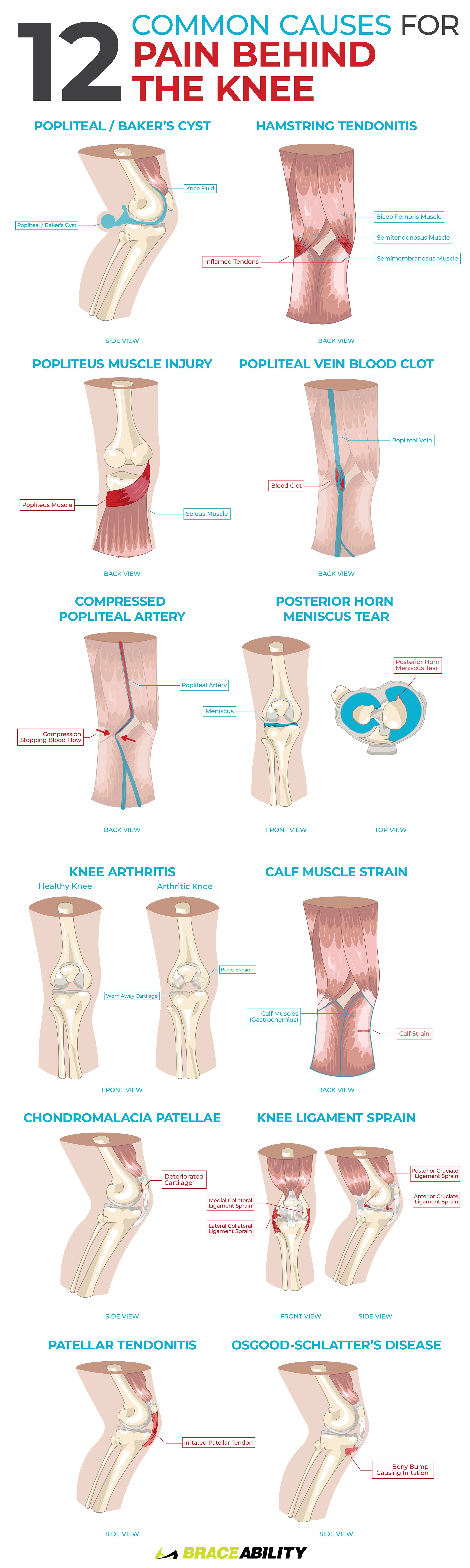 Pulled Muscle Behind Knee