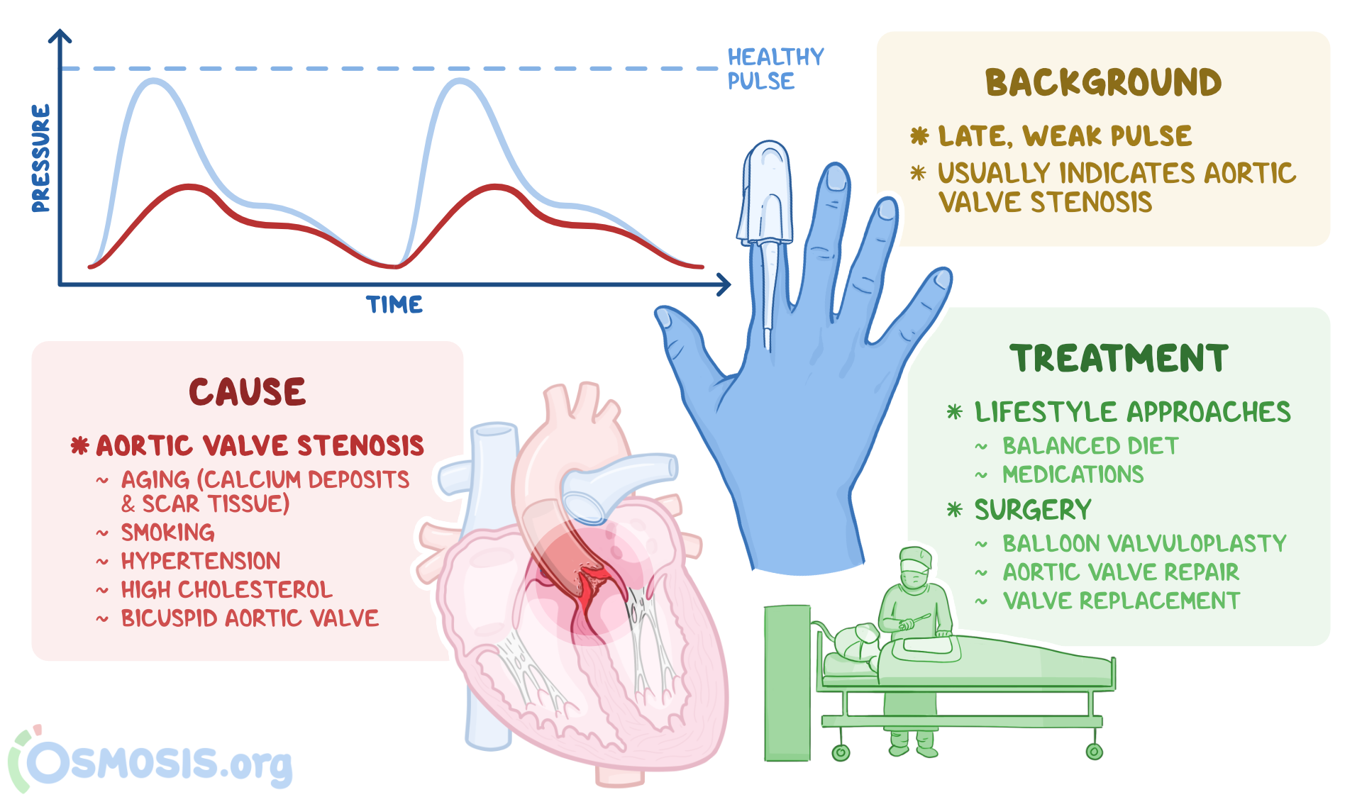 Pulsus Parvus Et Tardus