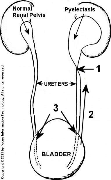 Pyelectasis Of Fetus