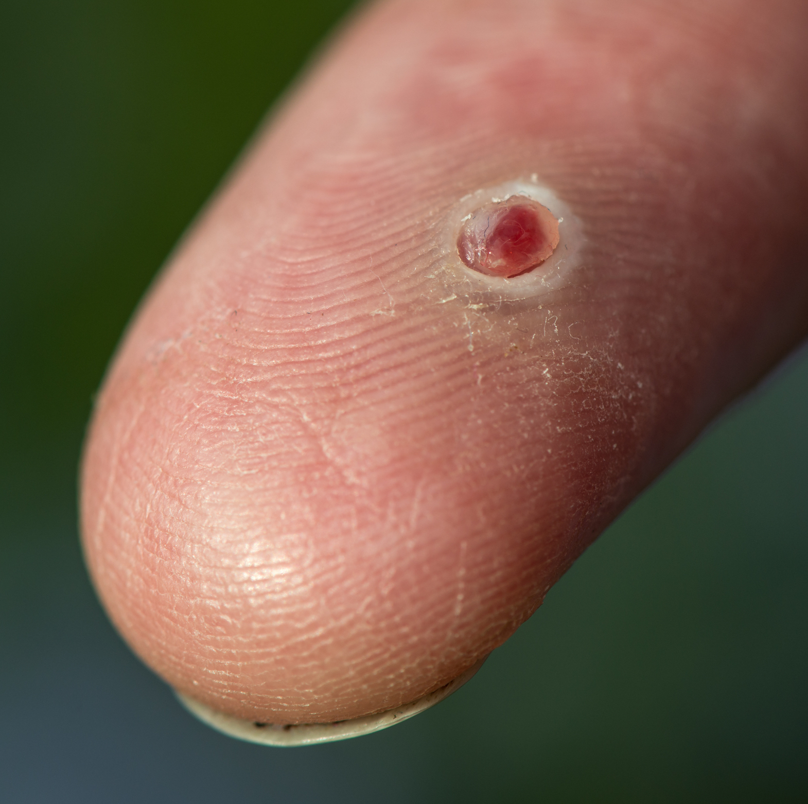 Pyogenic Granuloma Treatment