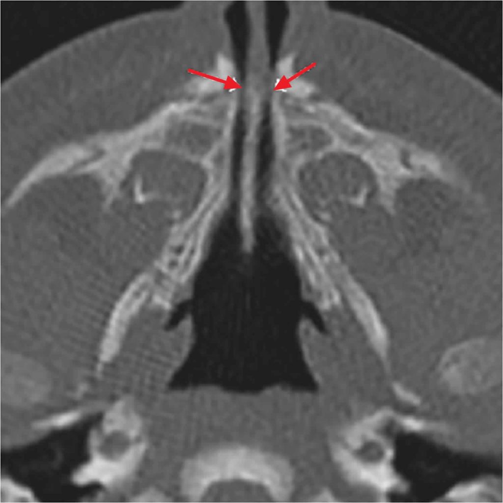Pyriform Aperture Stenosis