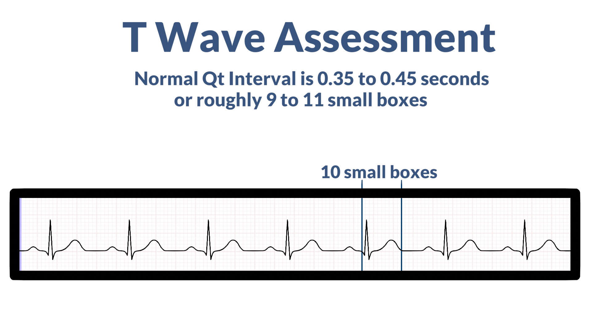 Qt Interval Normal Range