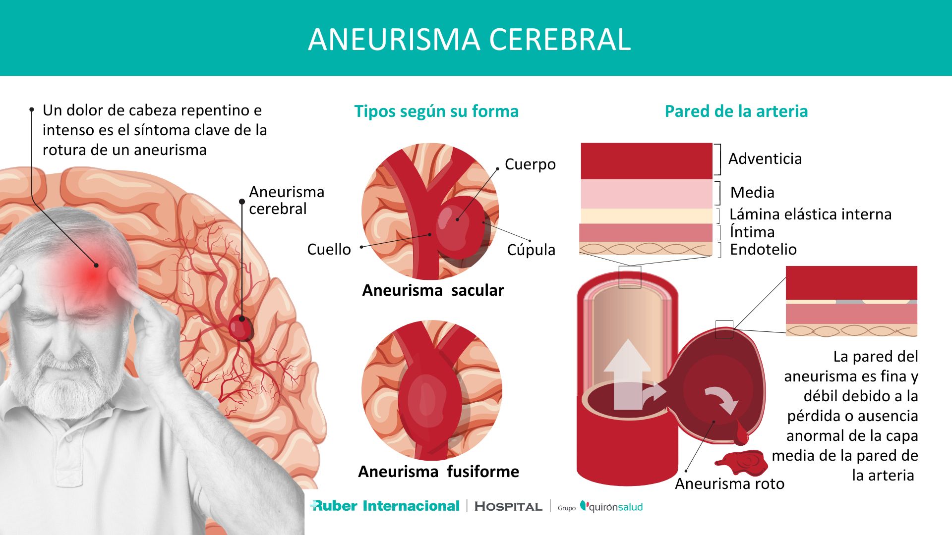 Que Es Aneurisma Cerebral