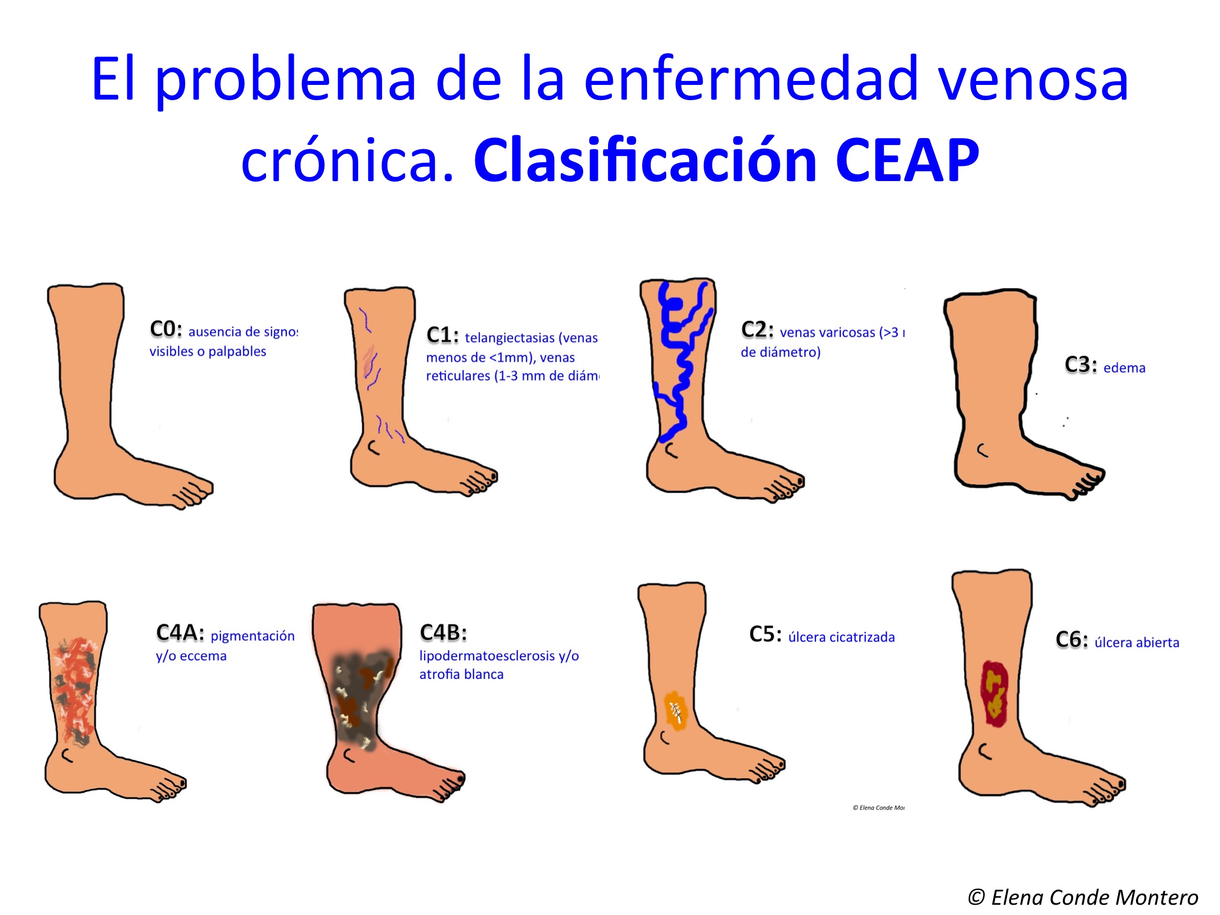 Que Es Insuficiencia Venosa