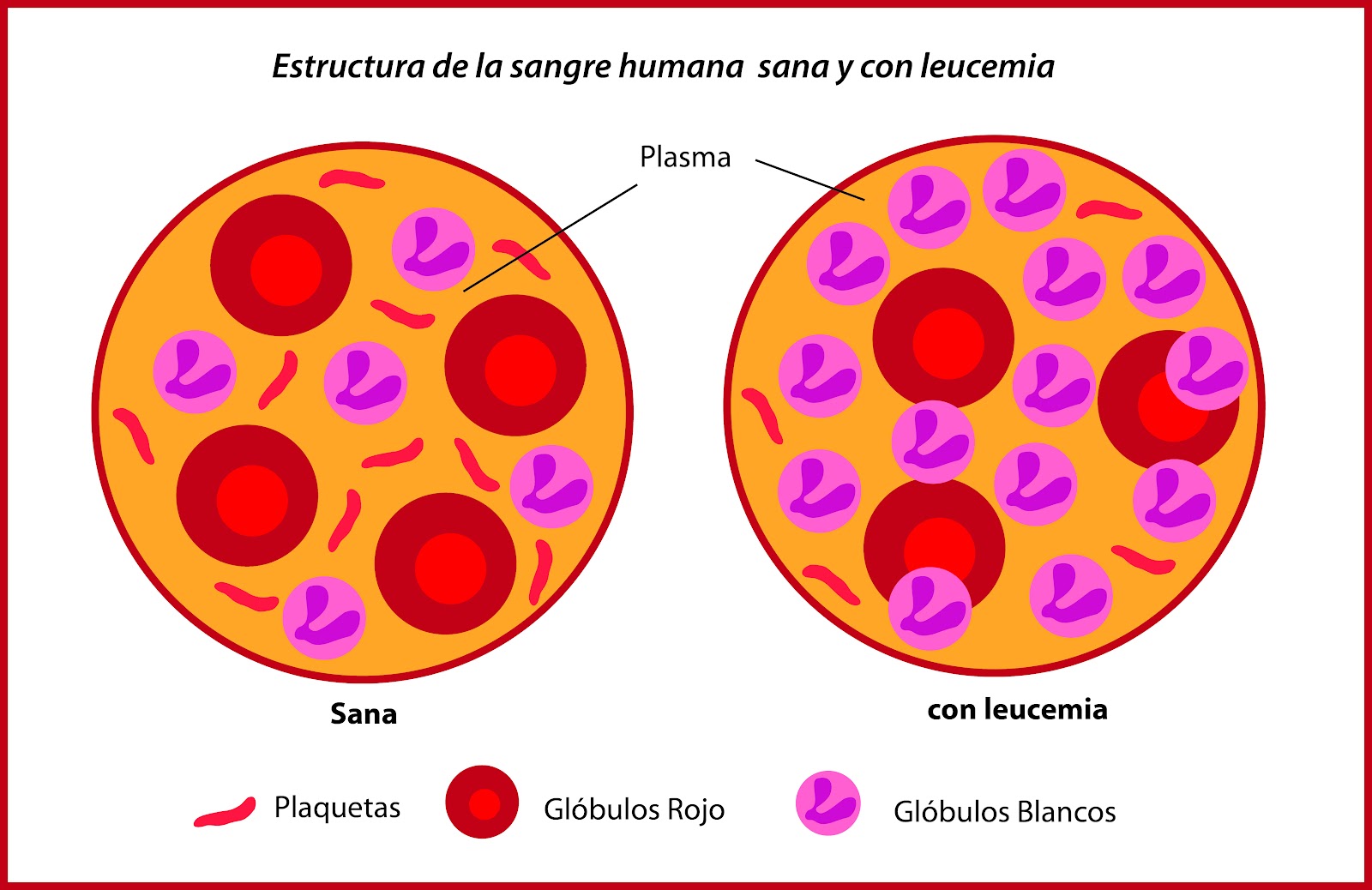 Que Es La Leucemia