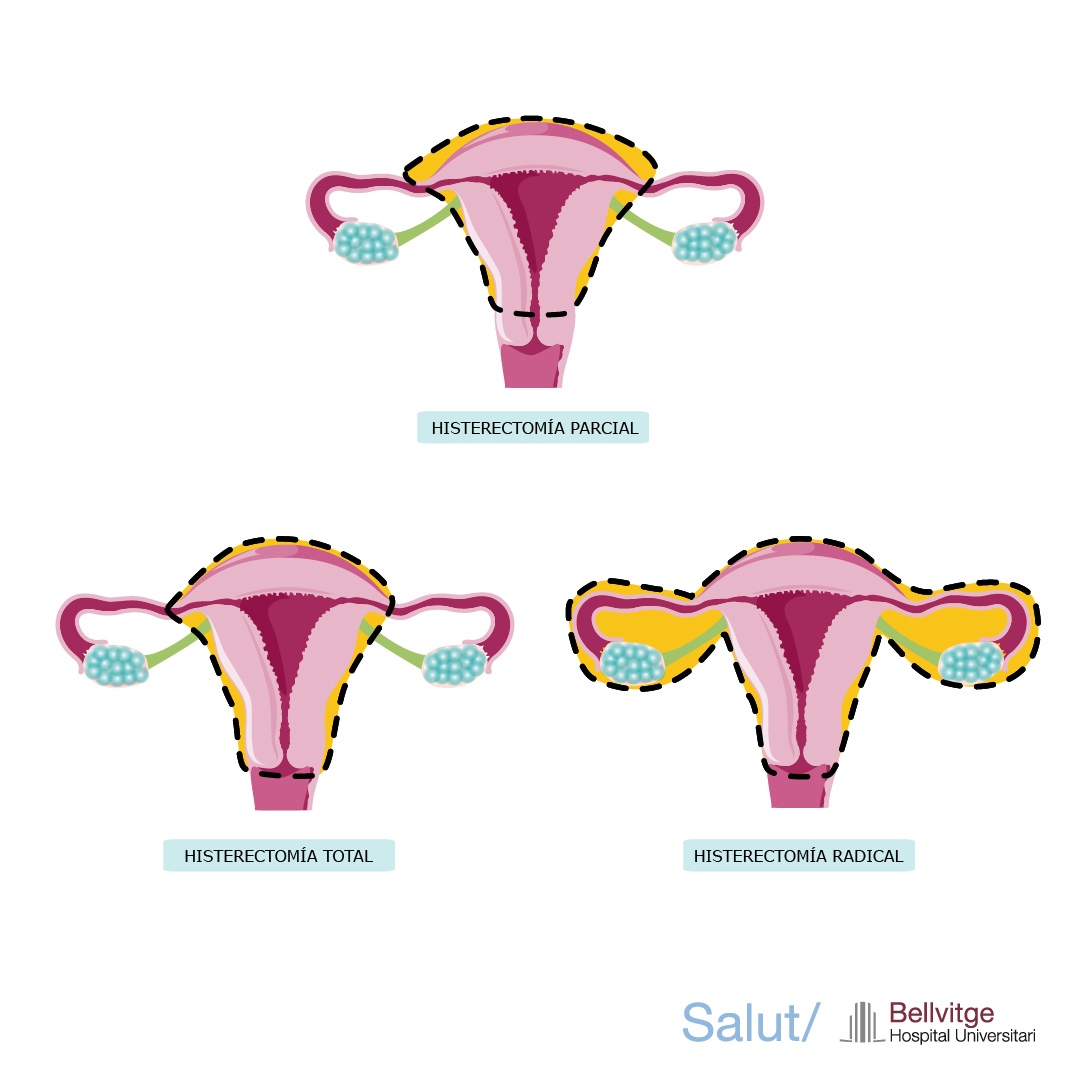 Que Es Una Histerectomia