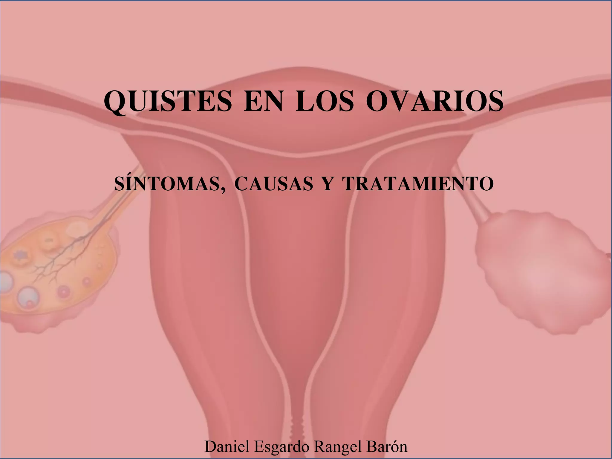 Quistes En Los Ovarios