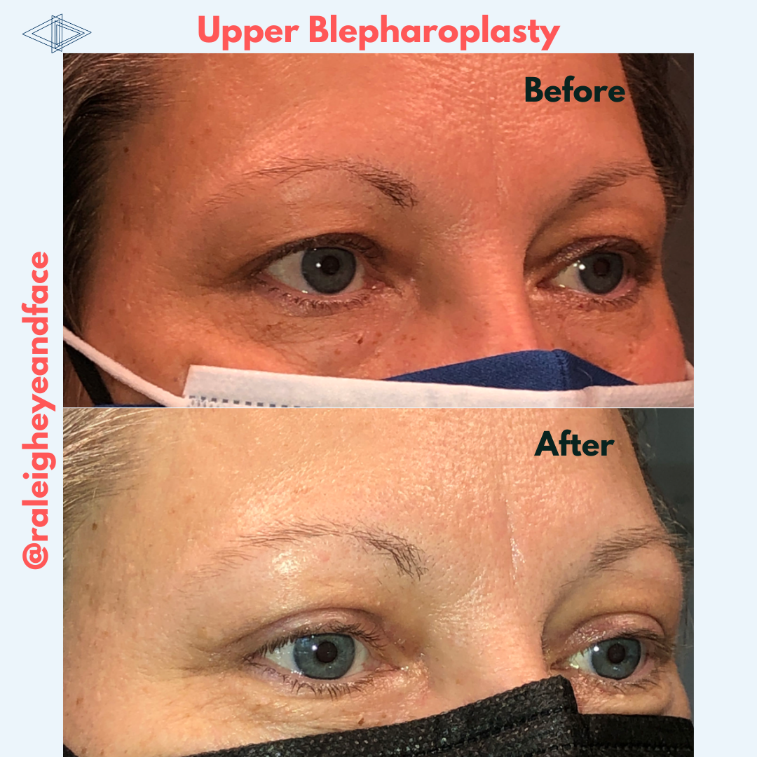 Raleigh Eye And Face Plastic Surgery Photos