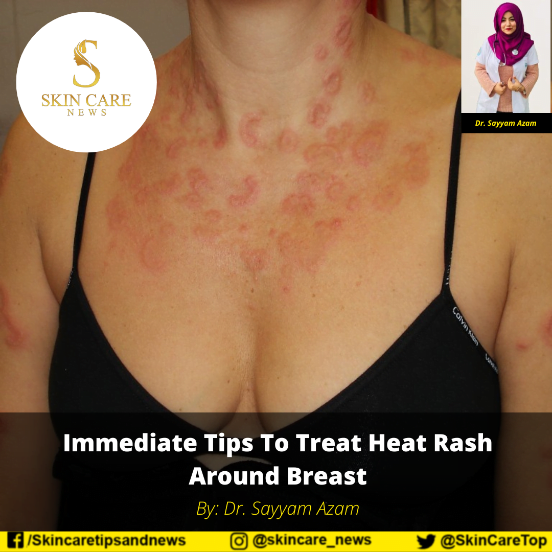 Rashes In The Breast