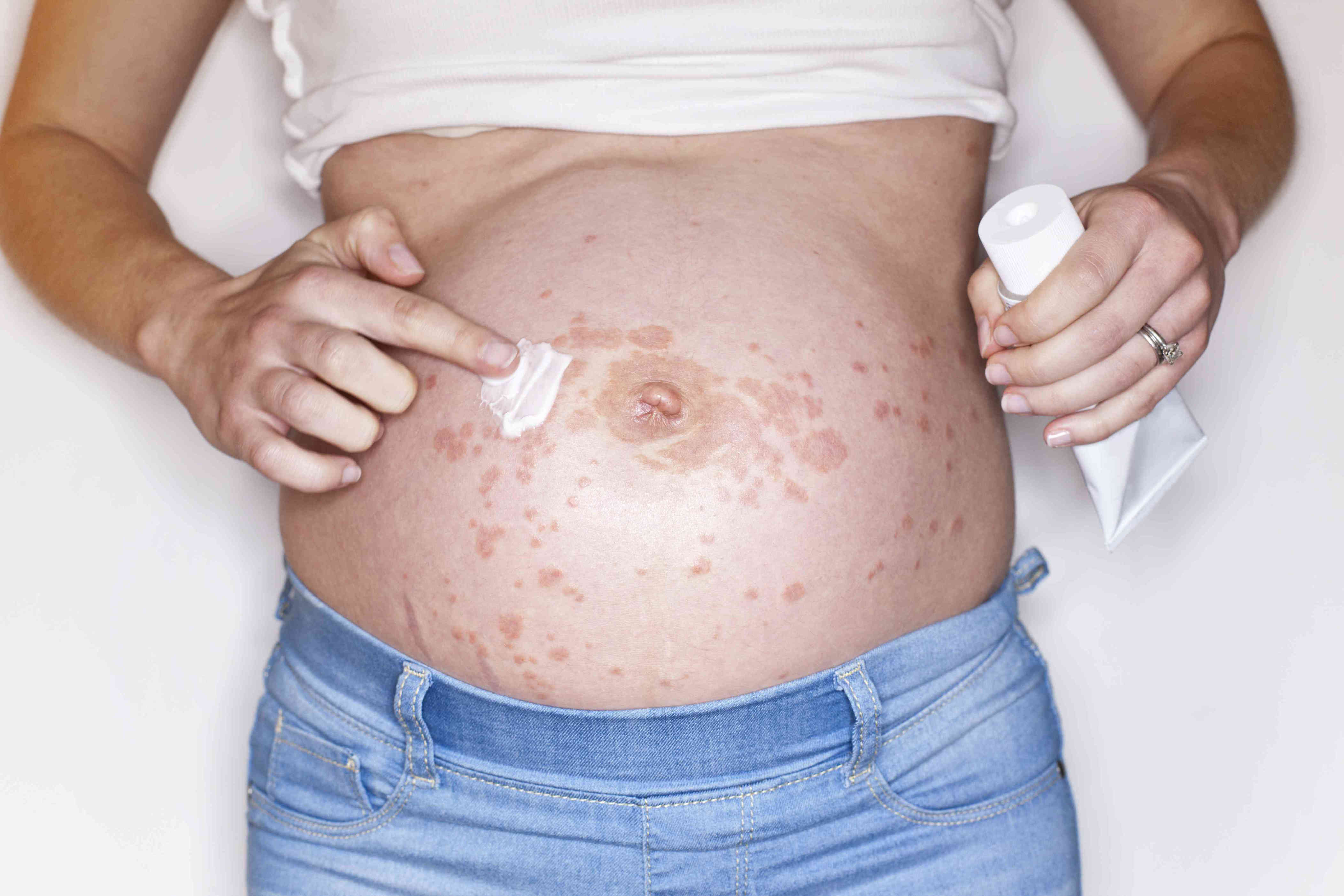Rashes Related To Pregnancy