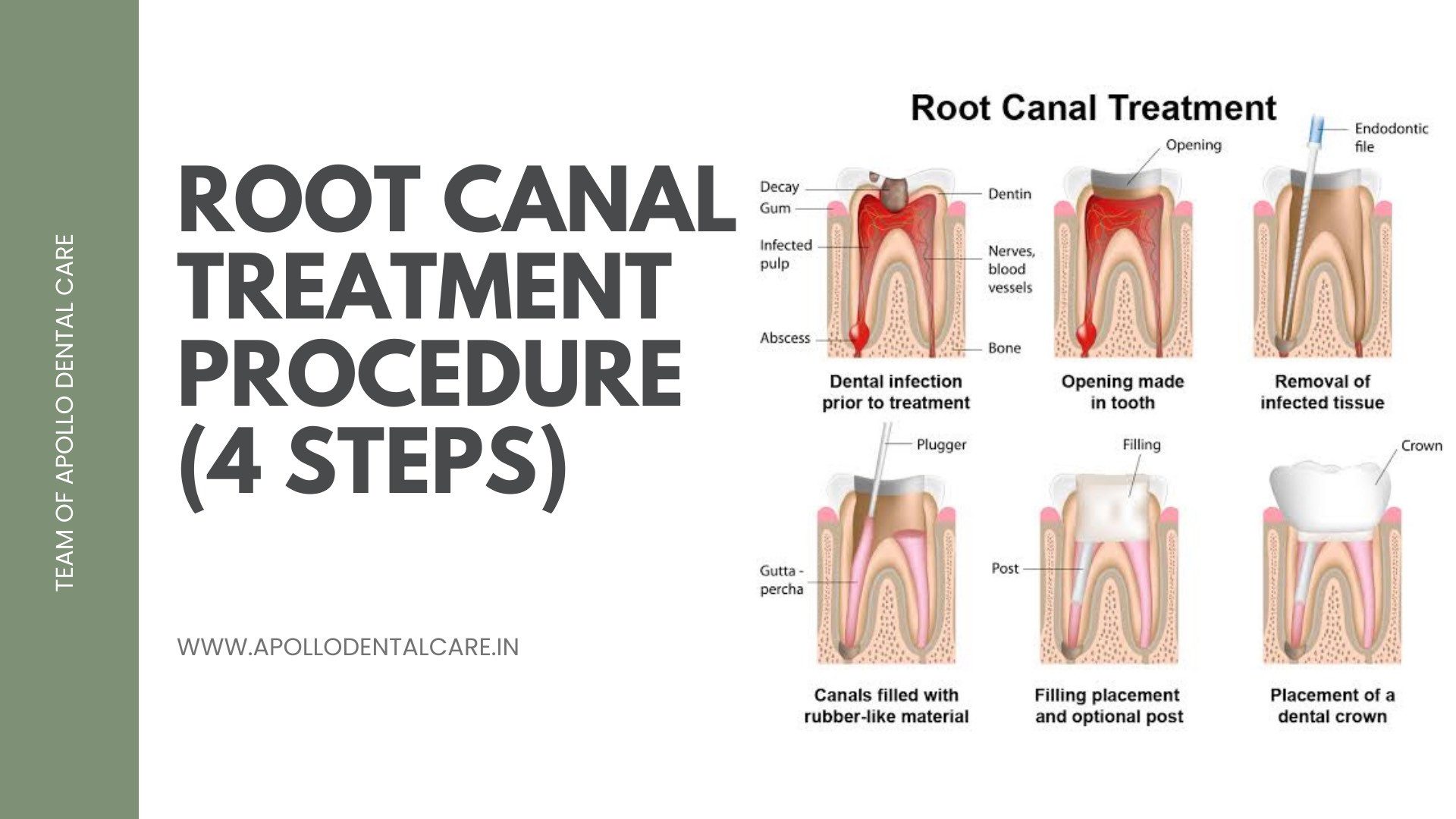 Rct Of Teeth