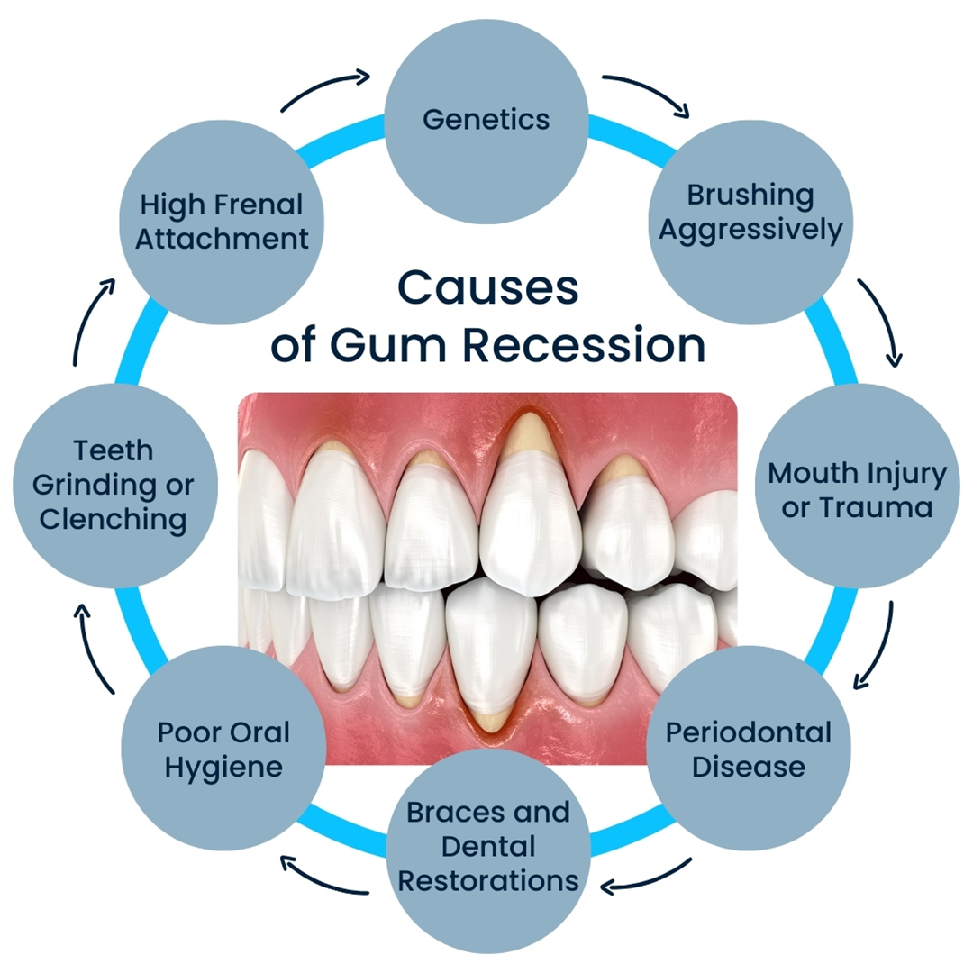 Reasons Gums Recede