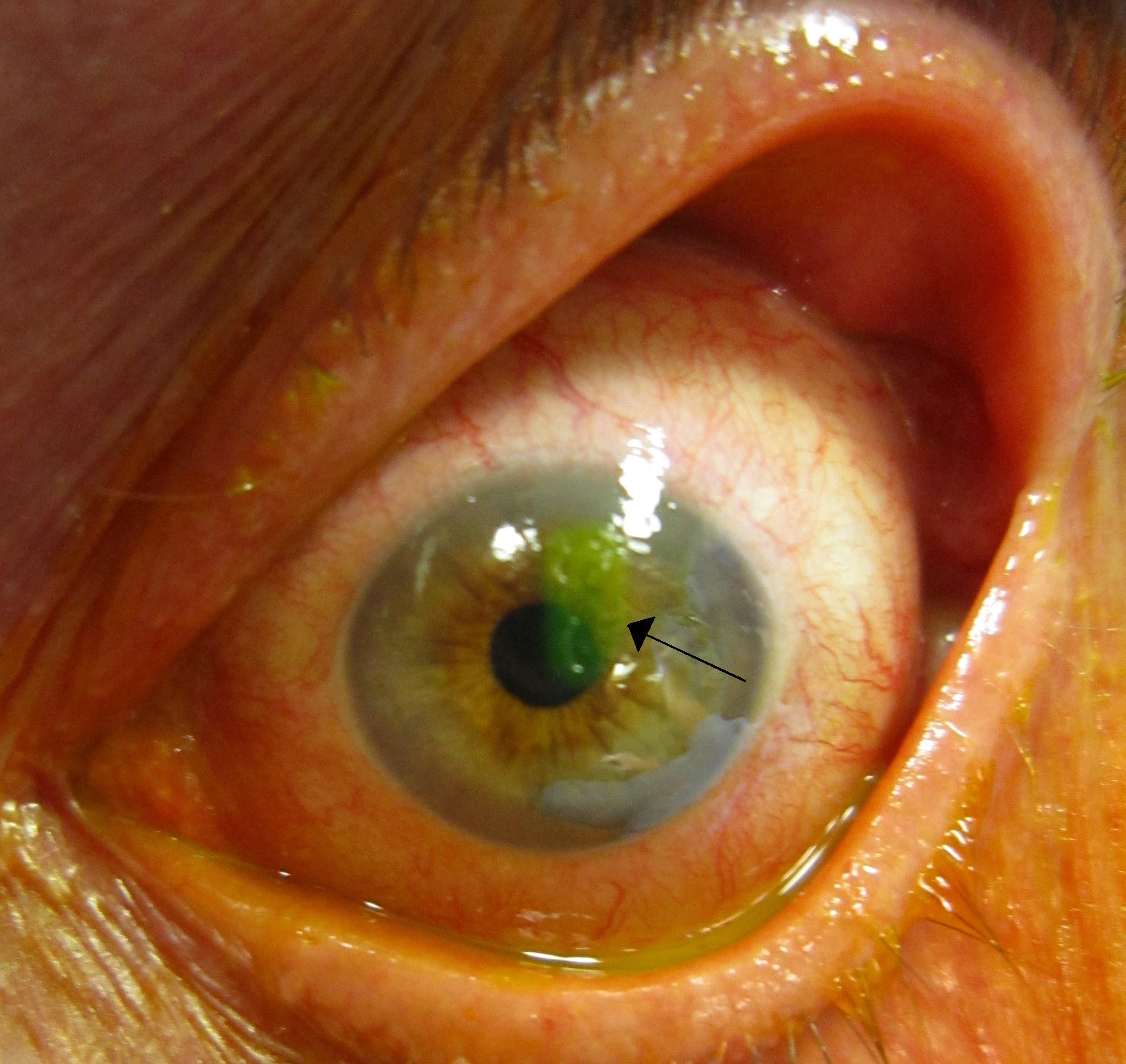 Recurrent Corneal Erosion