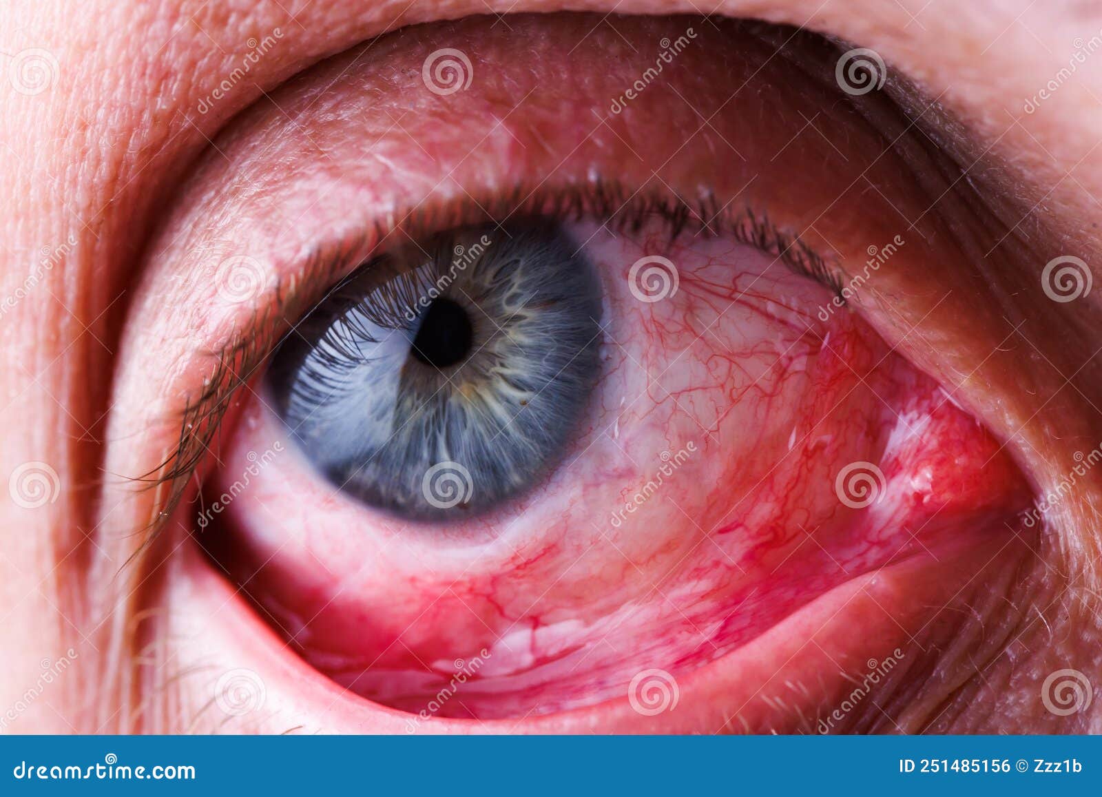 Red Lower Eyelid