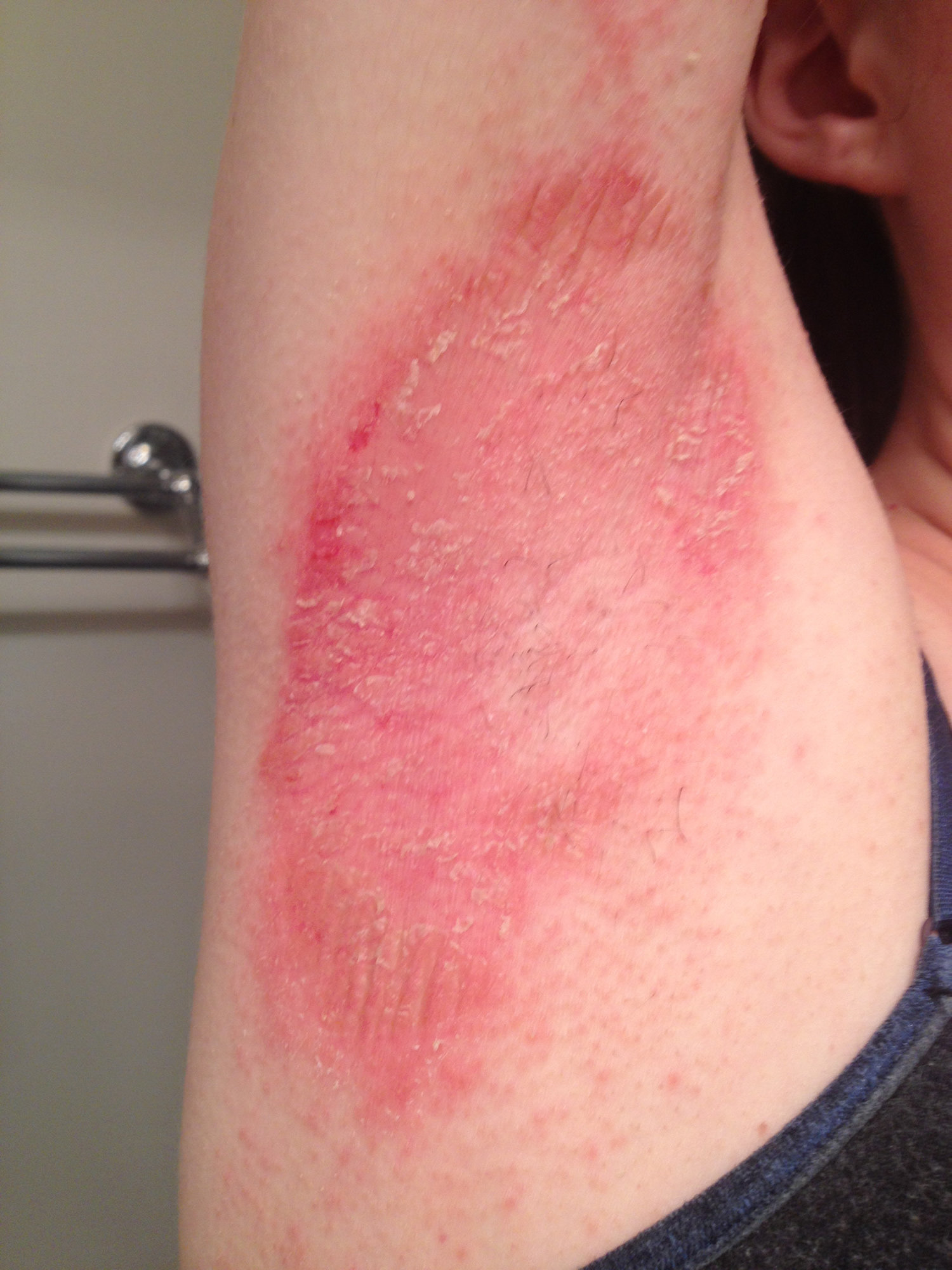 Red Rash Under Armpit
