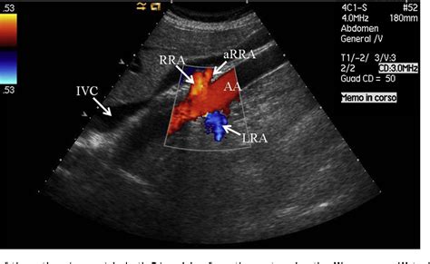 Renal Artery Ultrasound