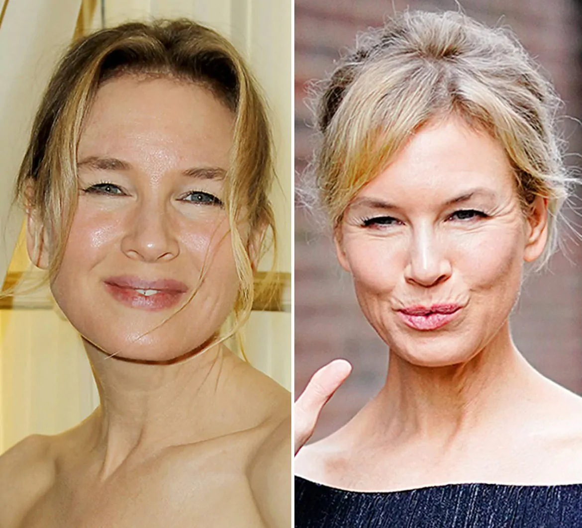 Renee Zellweger Face Surgery