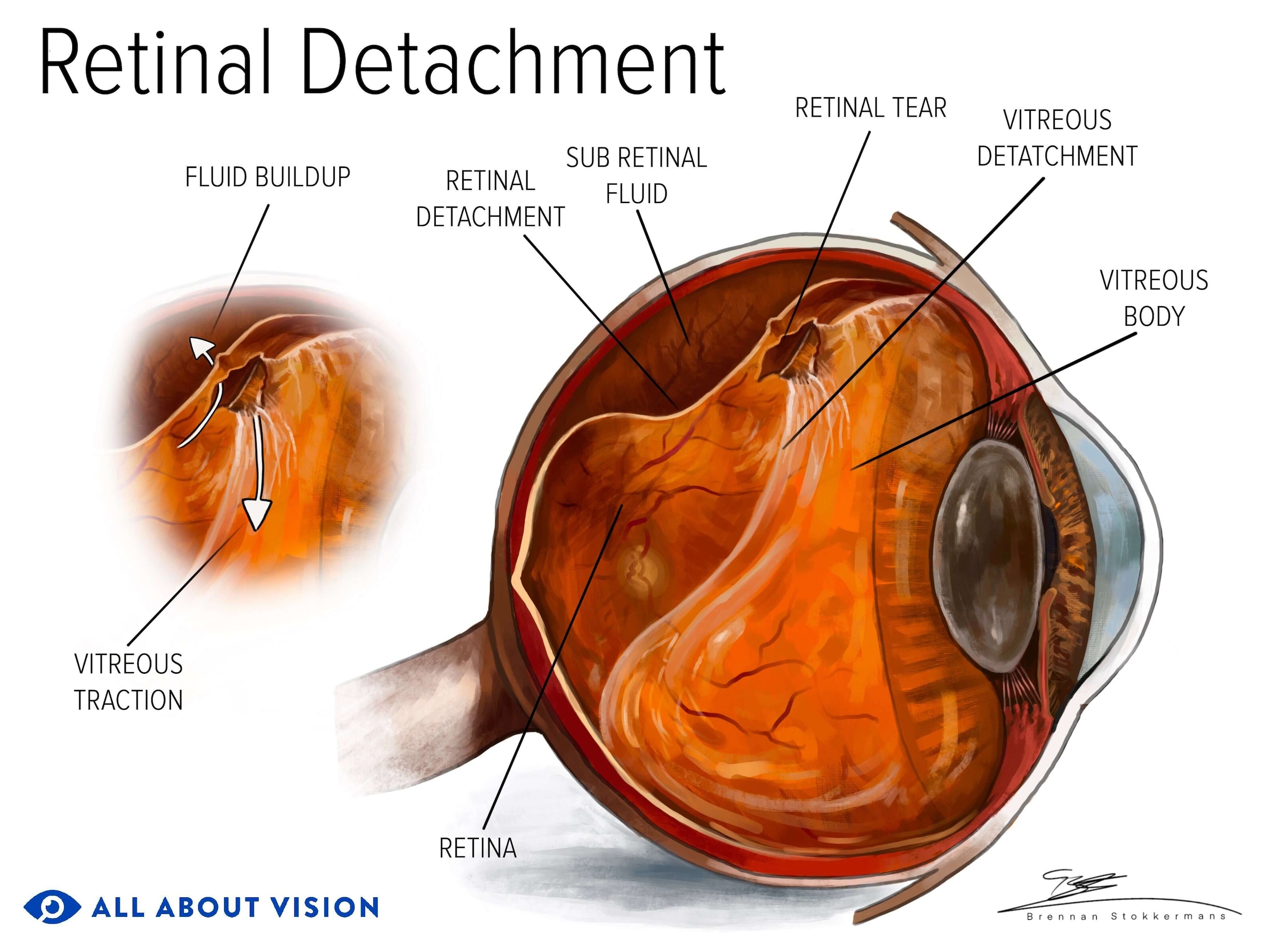 Retinal Detachment Operation Recovery