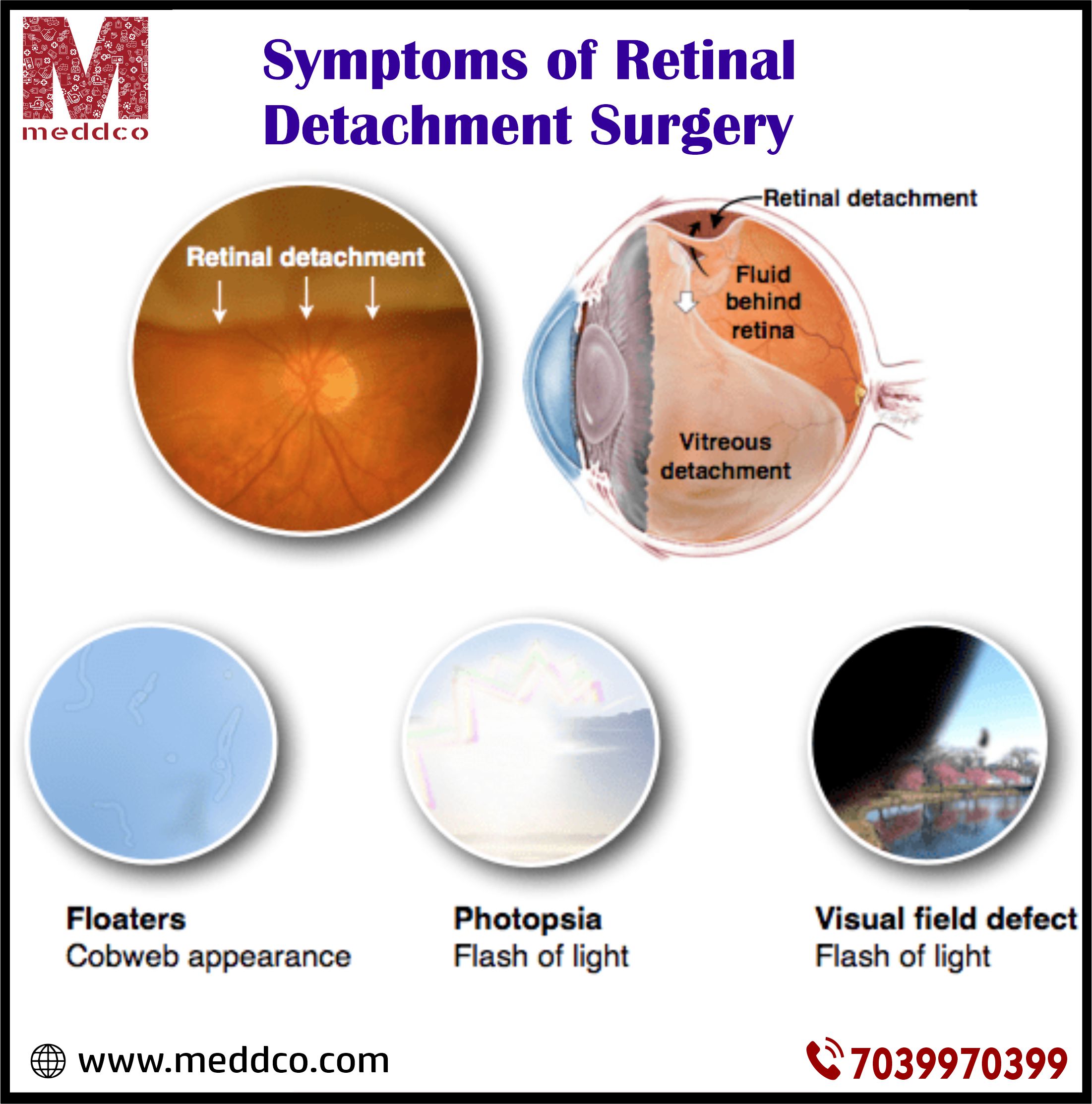 Retinal Tear Symptoms