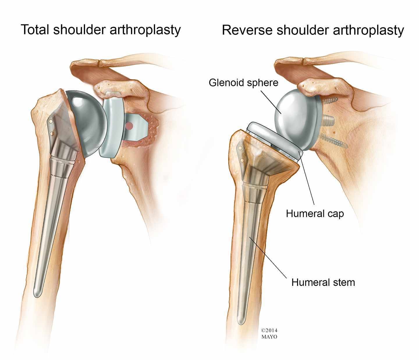 Reverse Shoulder Arthroplasty