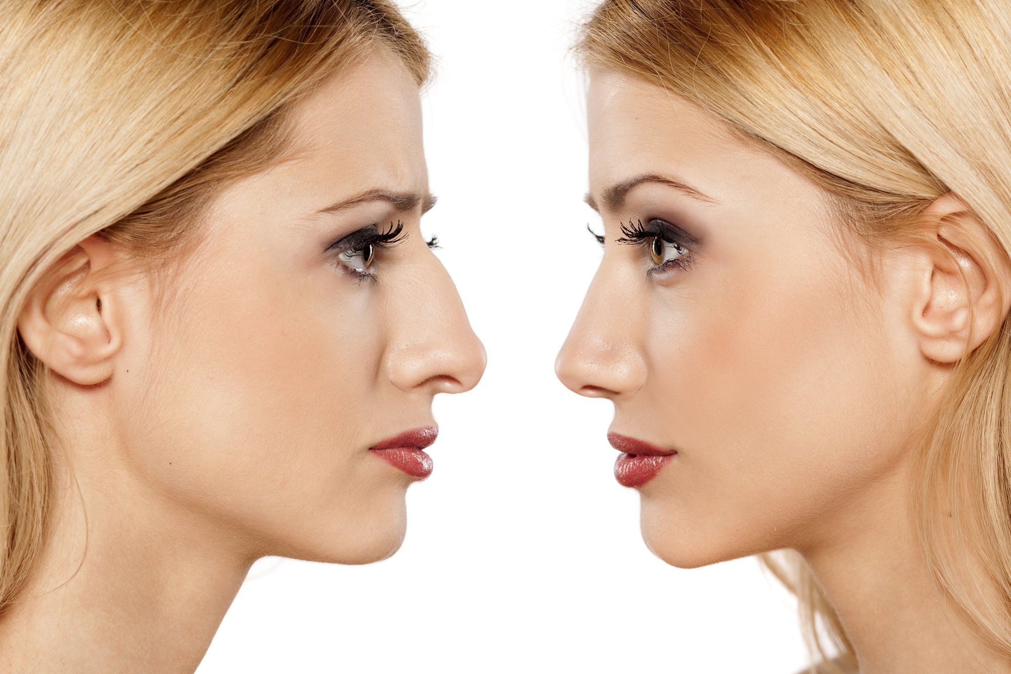 Rhinoplasty Recovery Time