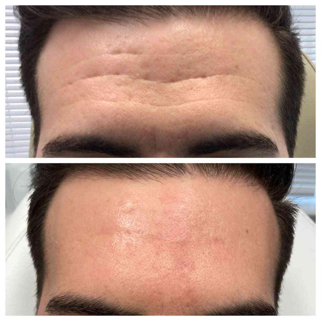 Rid Of Forehead Lines