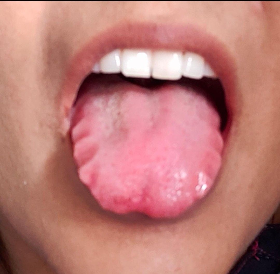 Ridges On Side Of Tongue