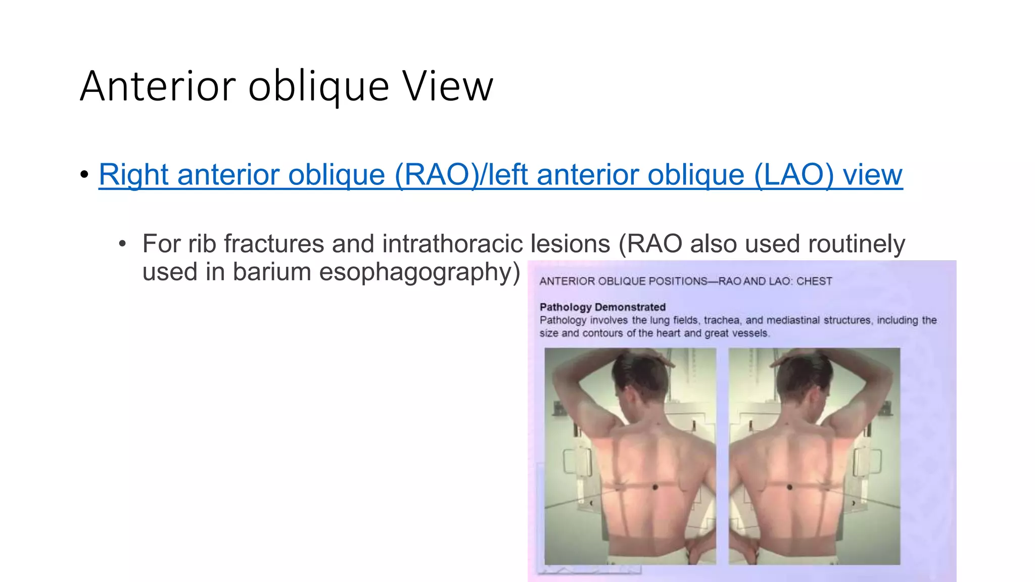 Right Anterior Oblique