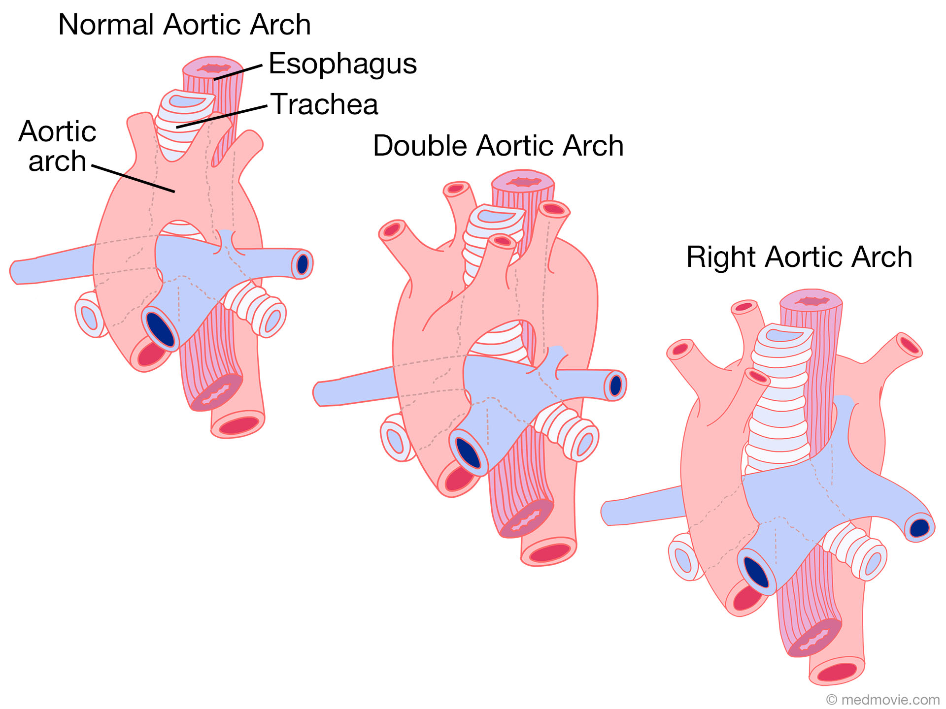 Right Aortic Arch