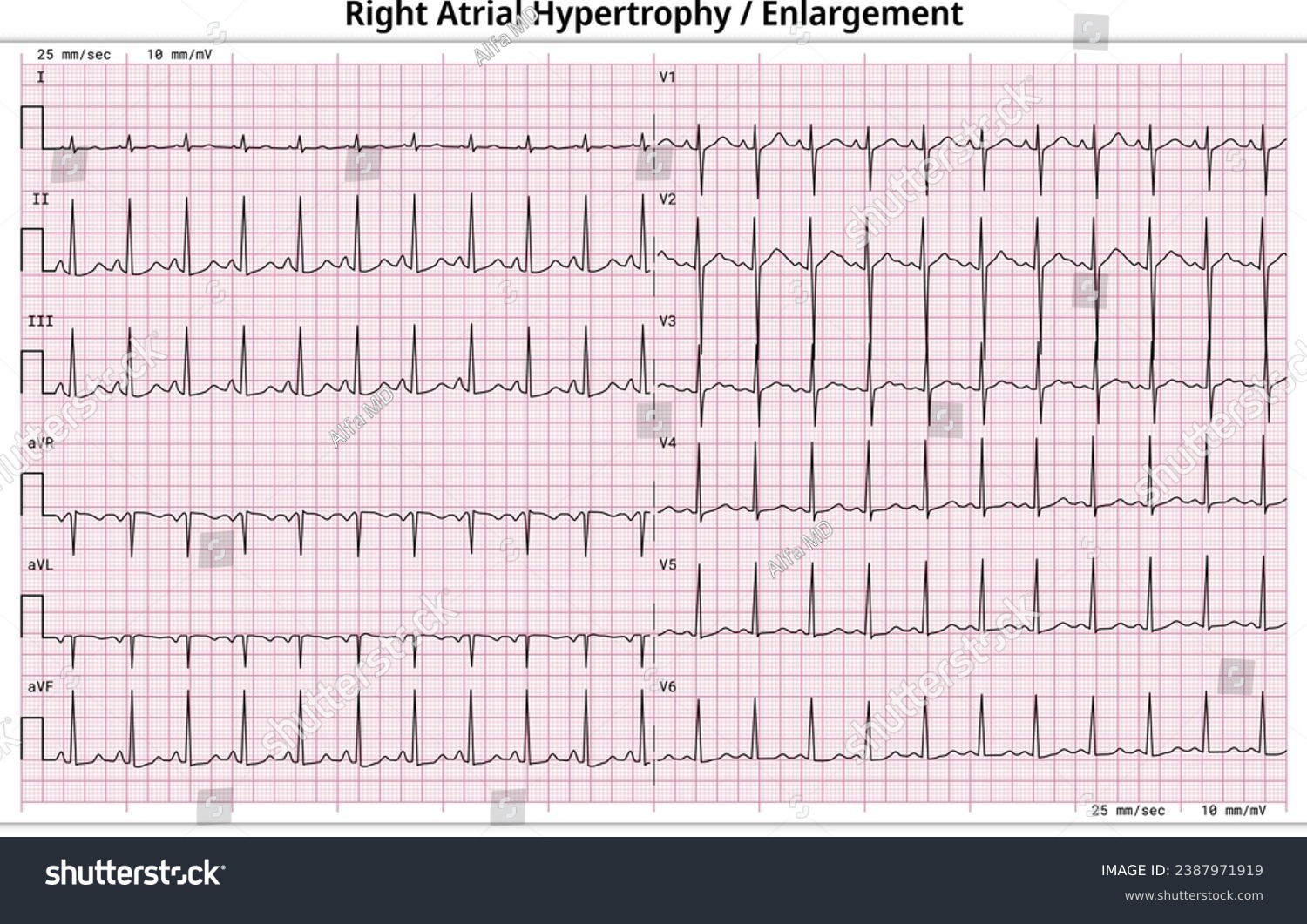 Right Atrial Enlargement On Ecg