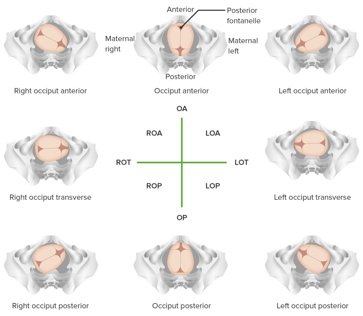 Right Occiput Anterior