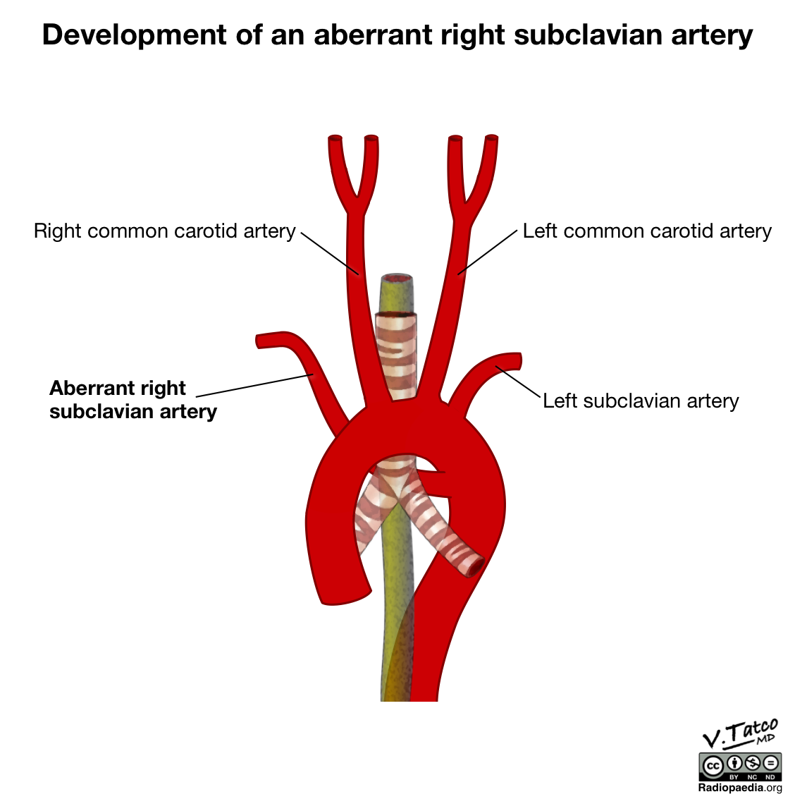 Right Subclavian Artery Aberrant