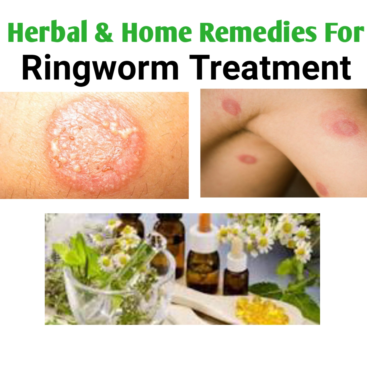 Ringworm On Penis