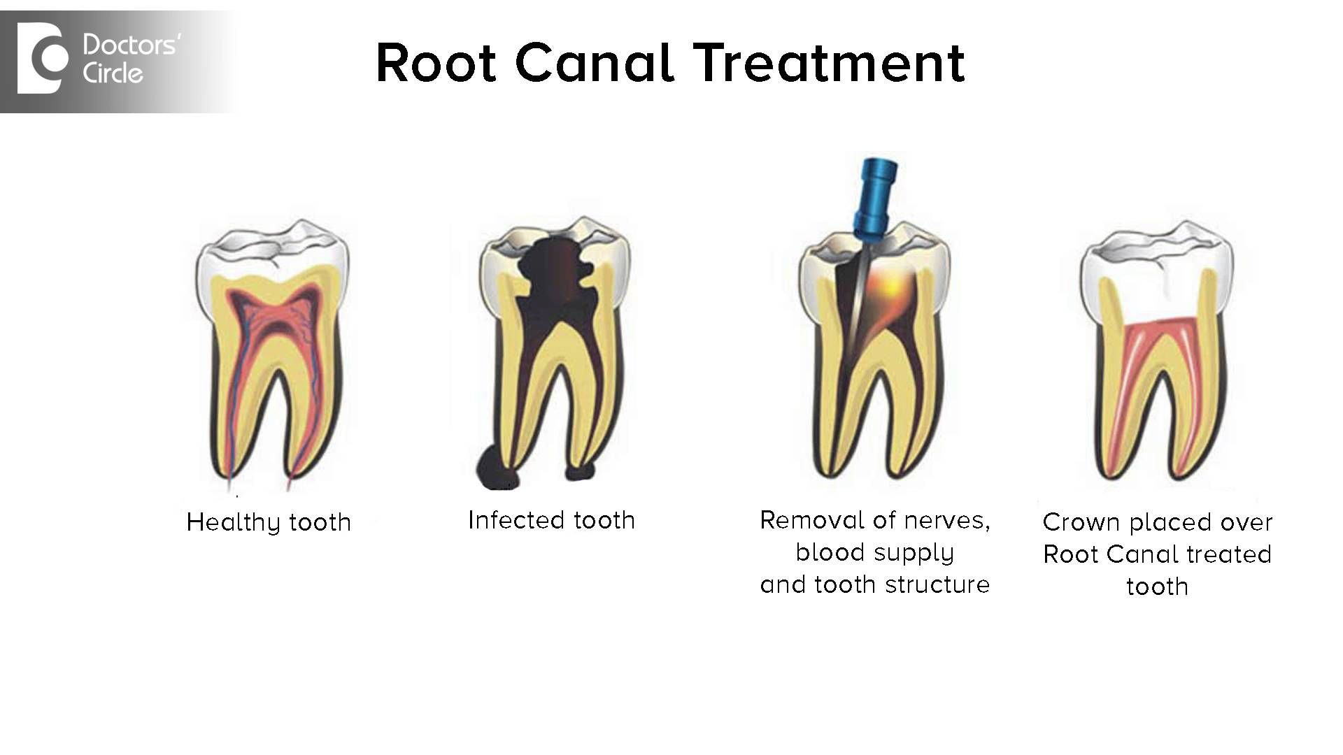 Root Canal And Crown