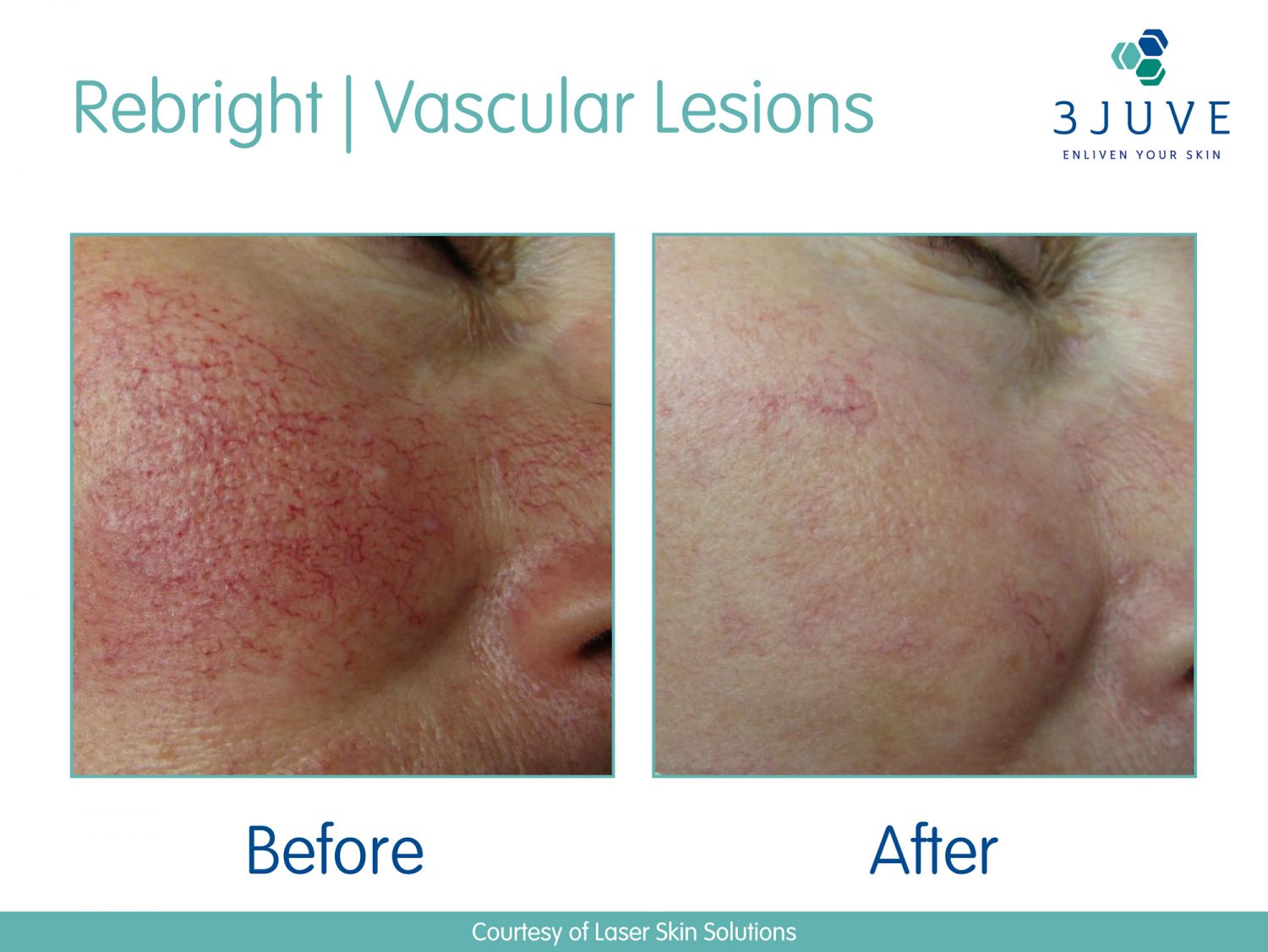 Rosacea Treatment Laser