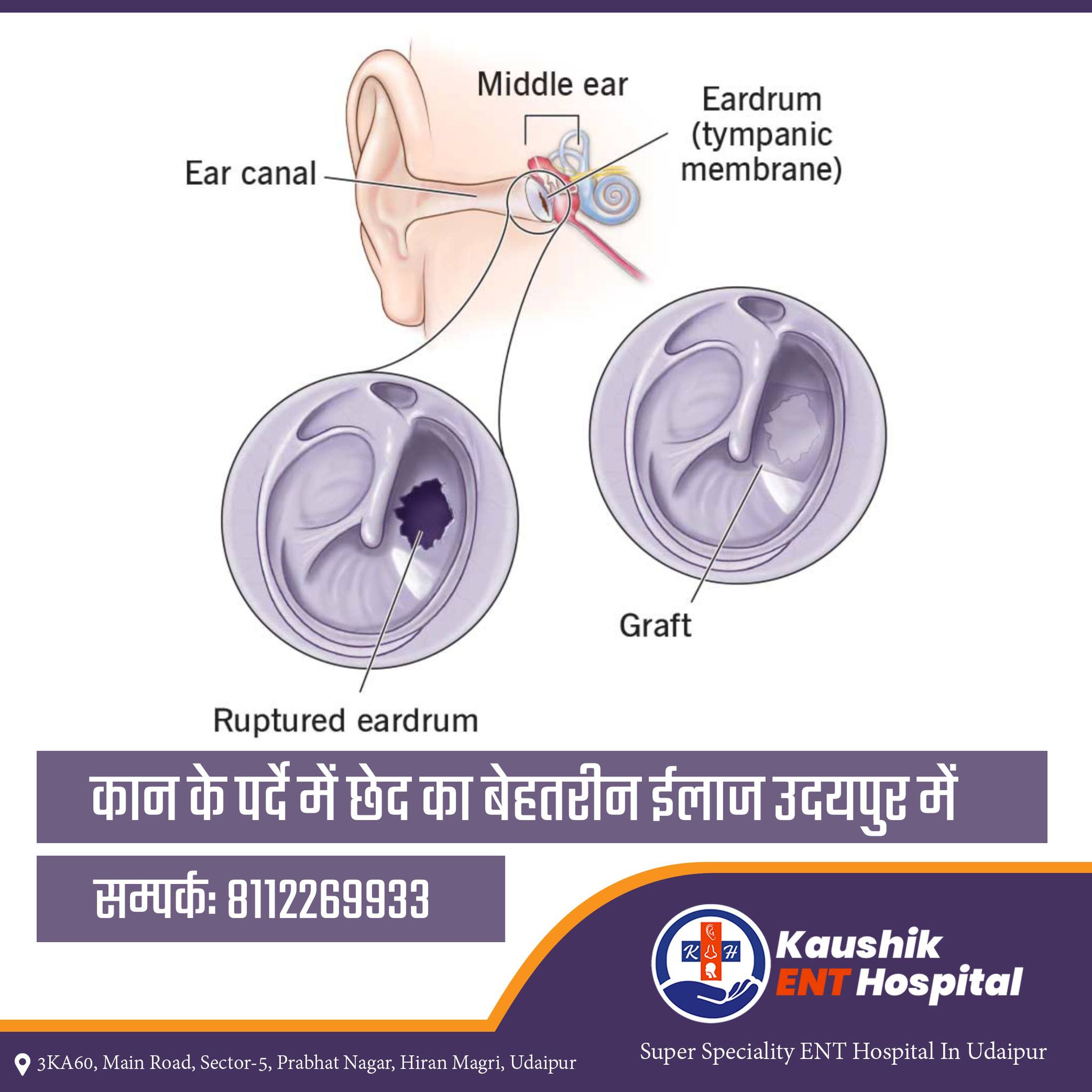 Ruptured Eardrum Photo