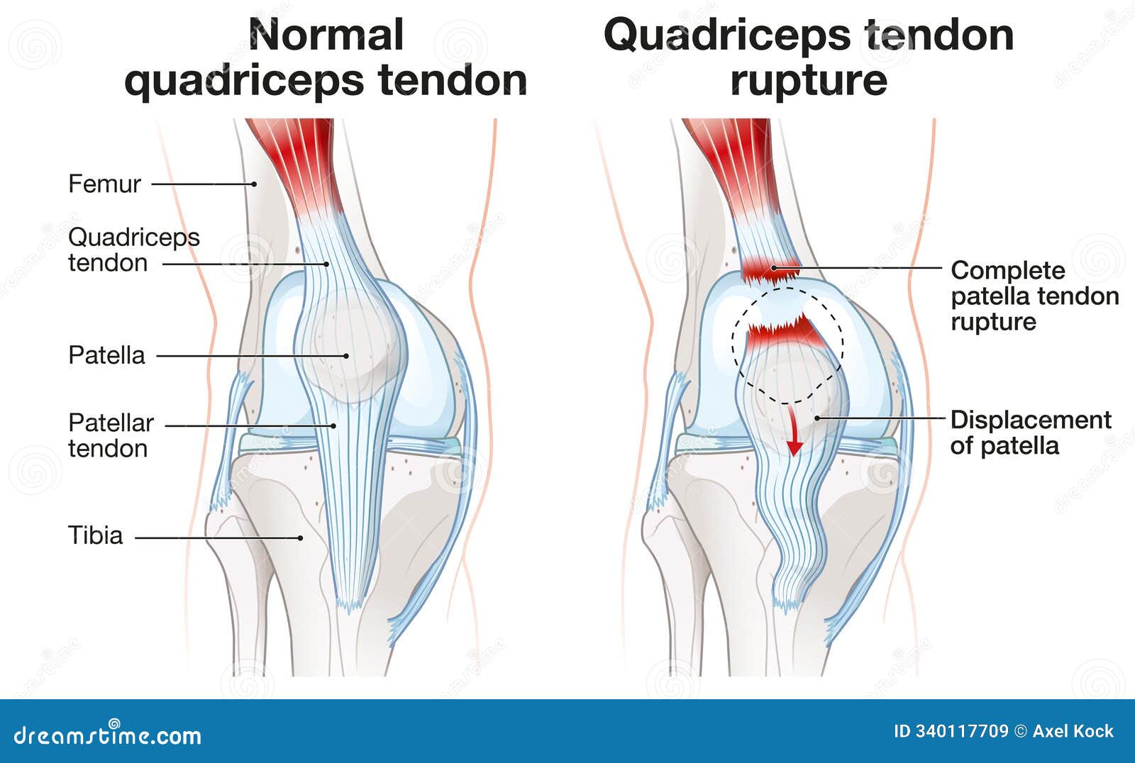 Ruptured Quad Muscle
