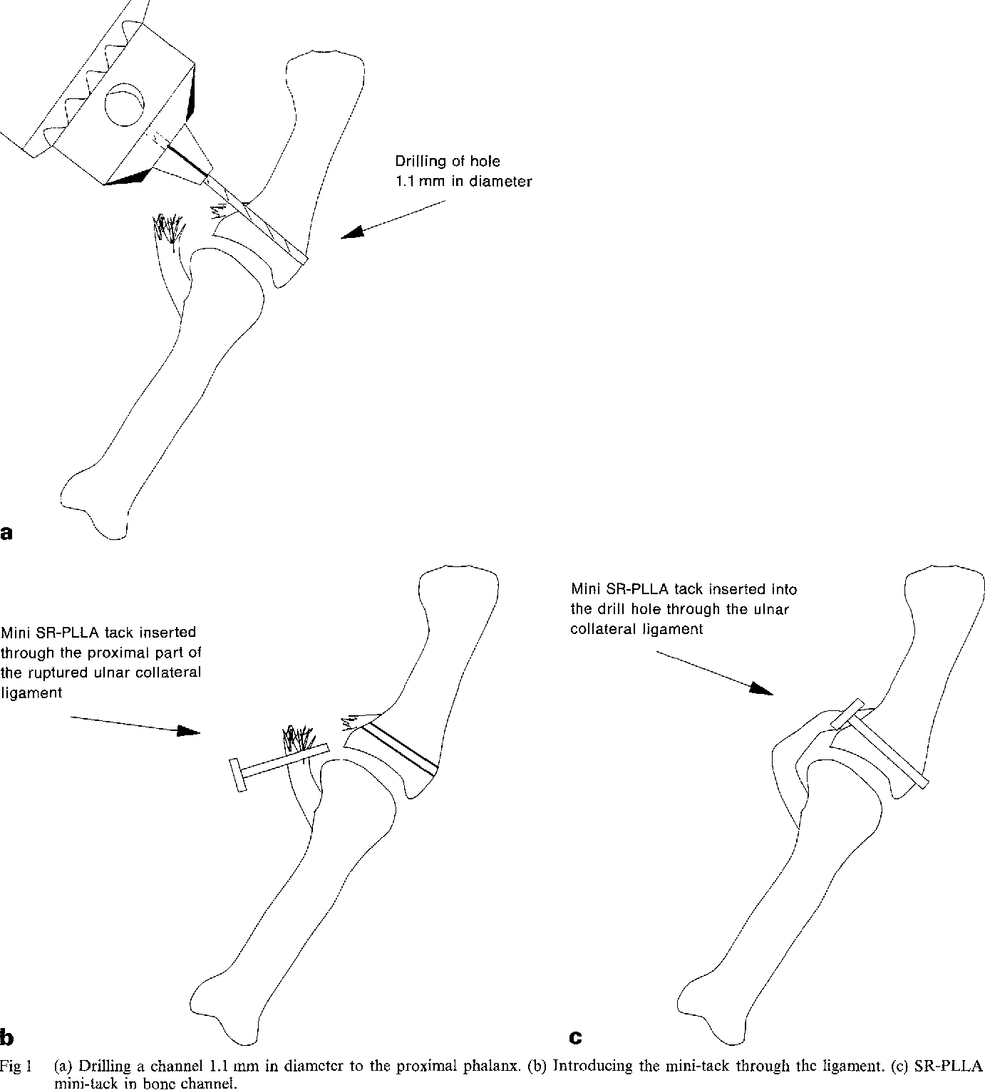 Ruptured Ulnar Collateral Ligament