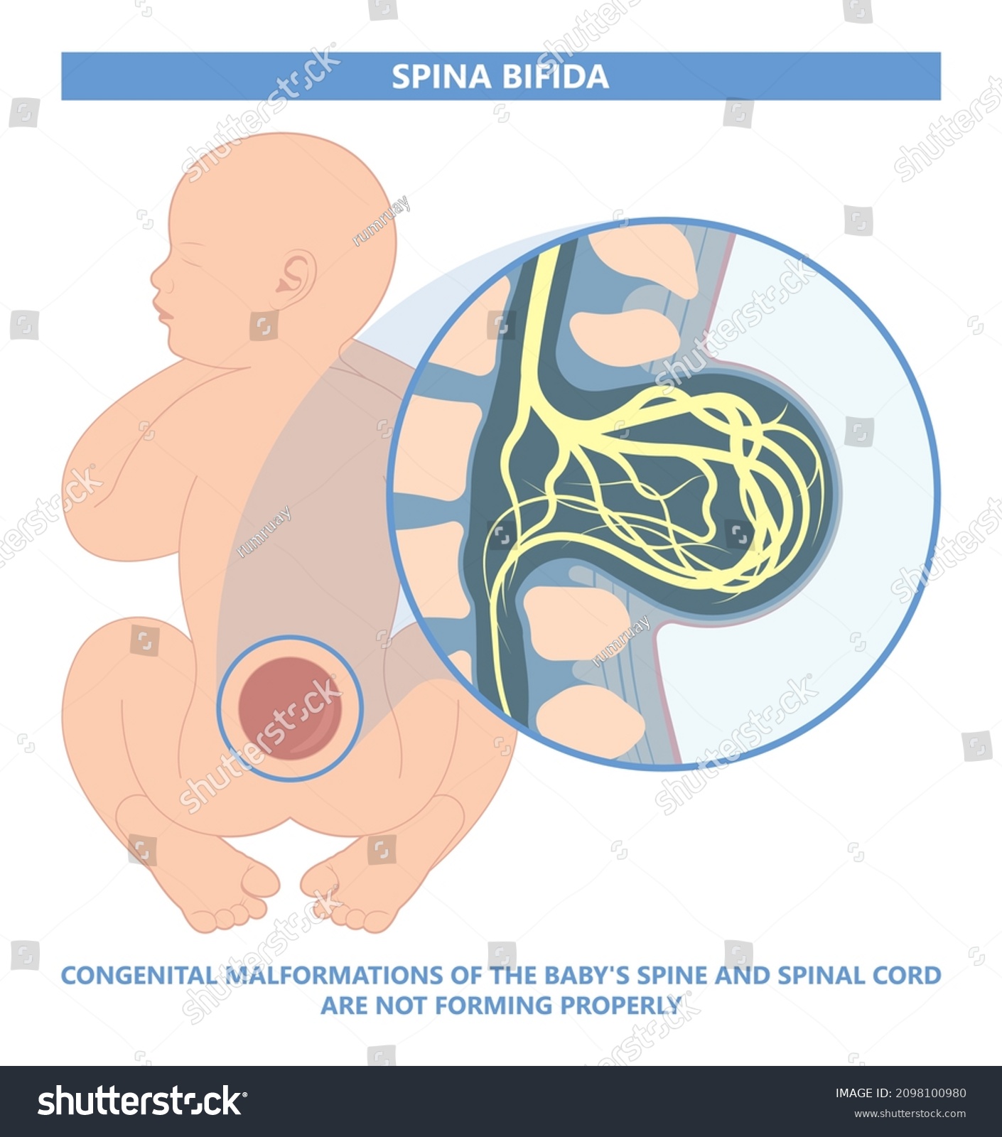 Sacral Dimple Newborn