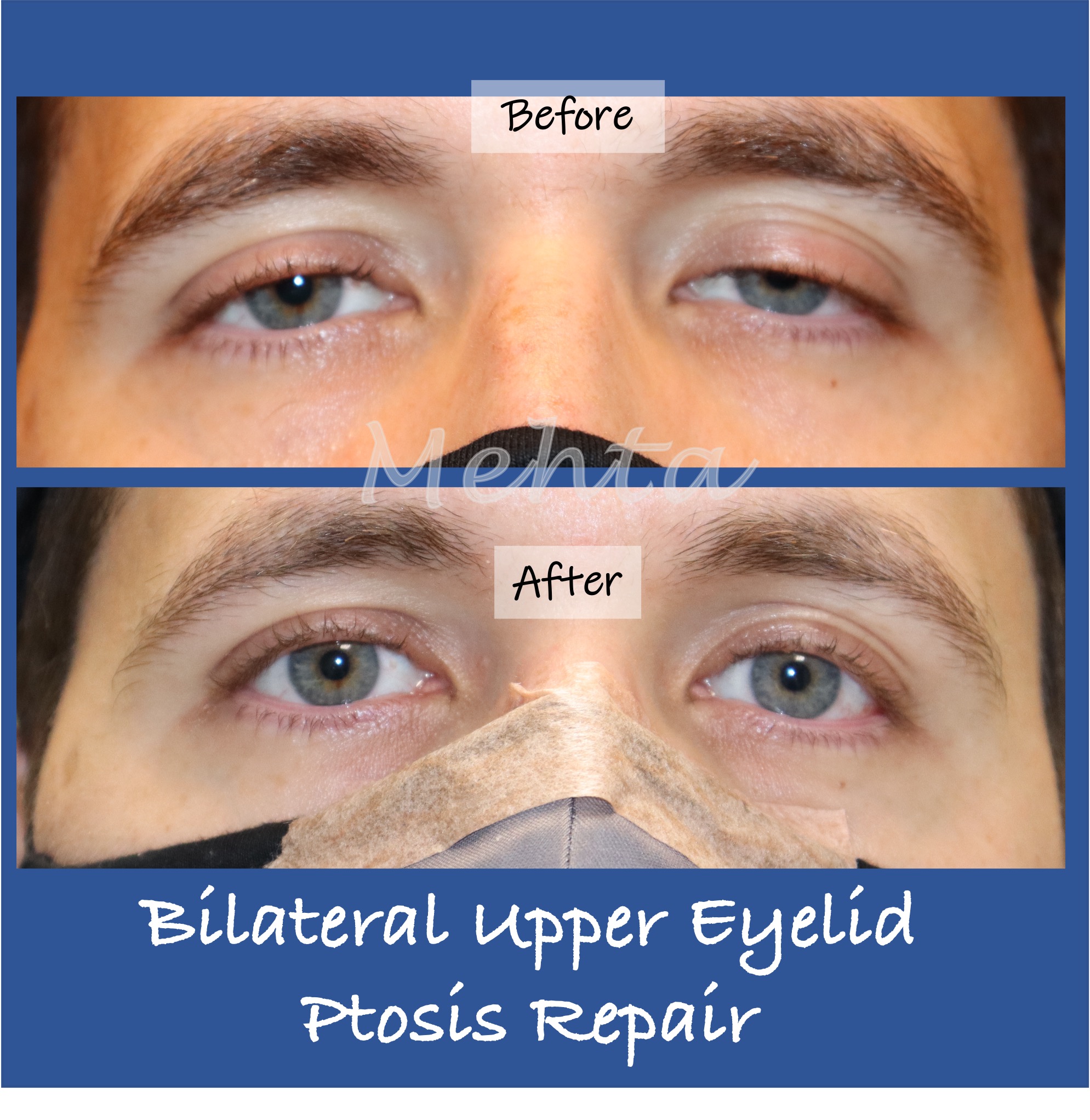 Sagging Eyelids Treatment