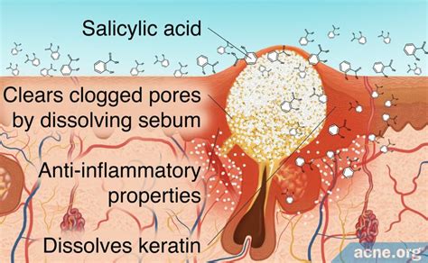 Salicylic Acid For Sebaceous Filaments