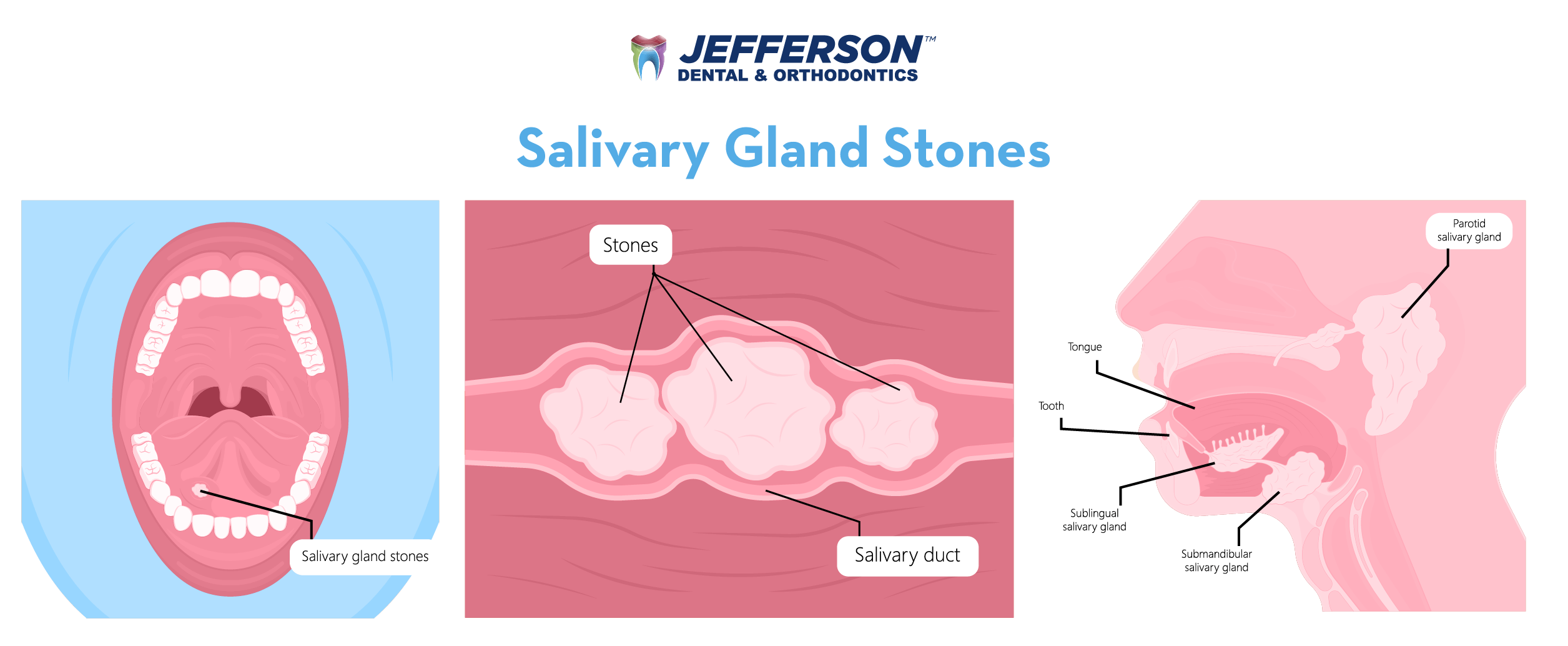 Salivary Gland Stone