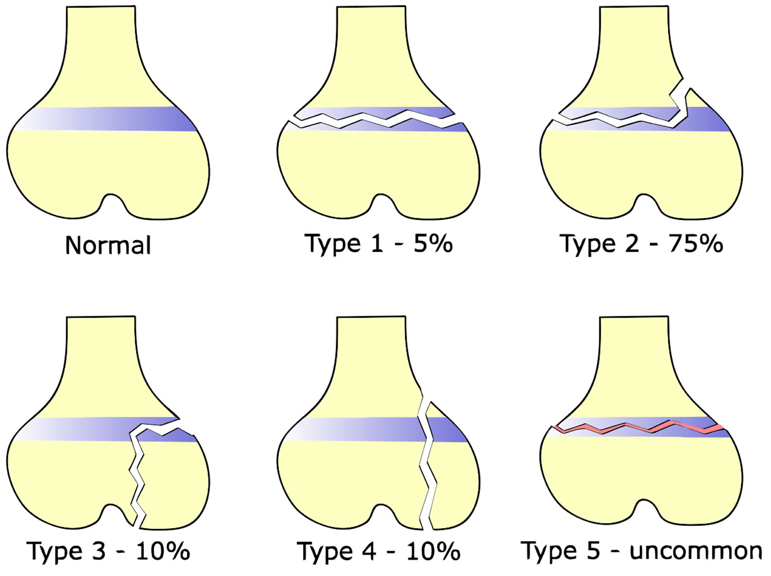 Salter Fracture Type 1