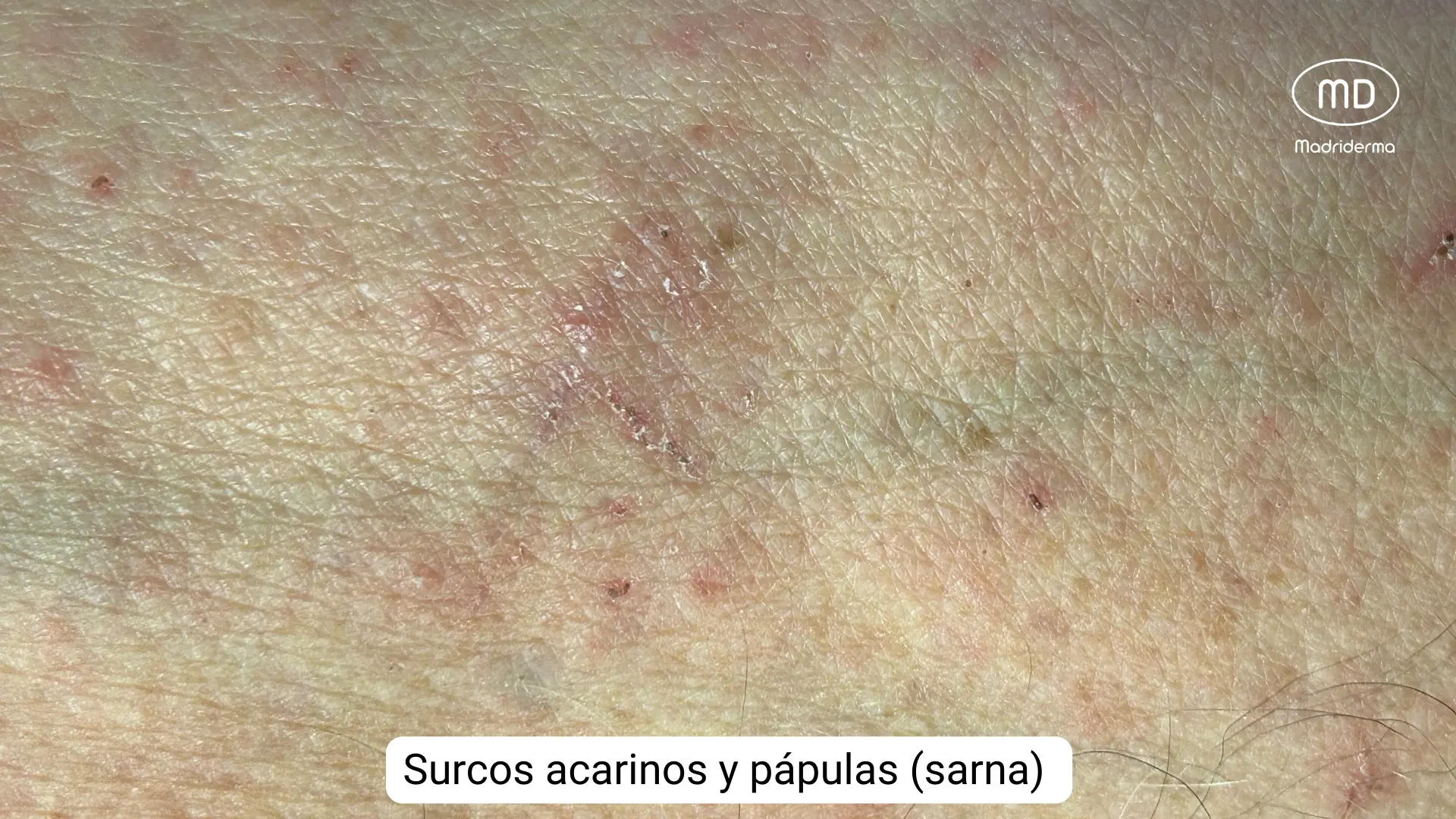 Sarna En Ingles