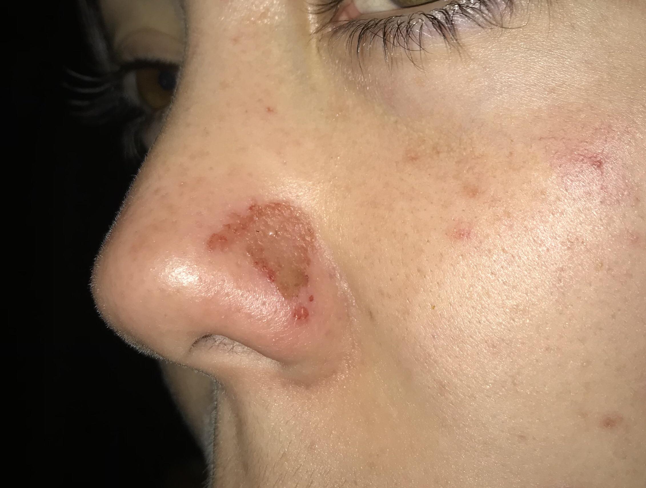 Scab In Nose Won't Heal